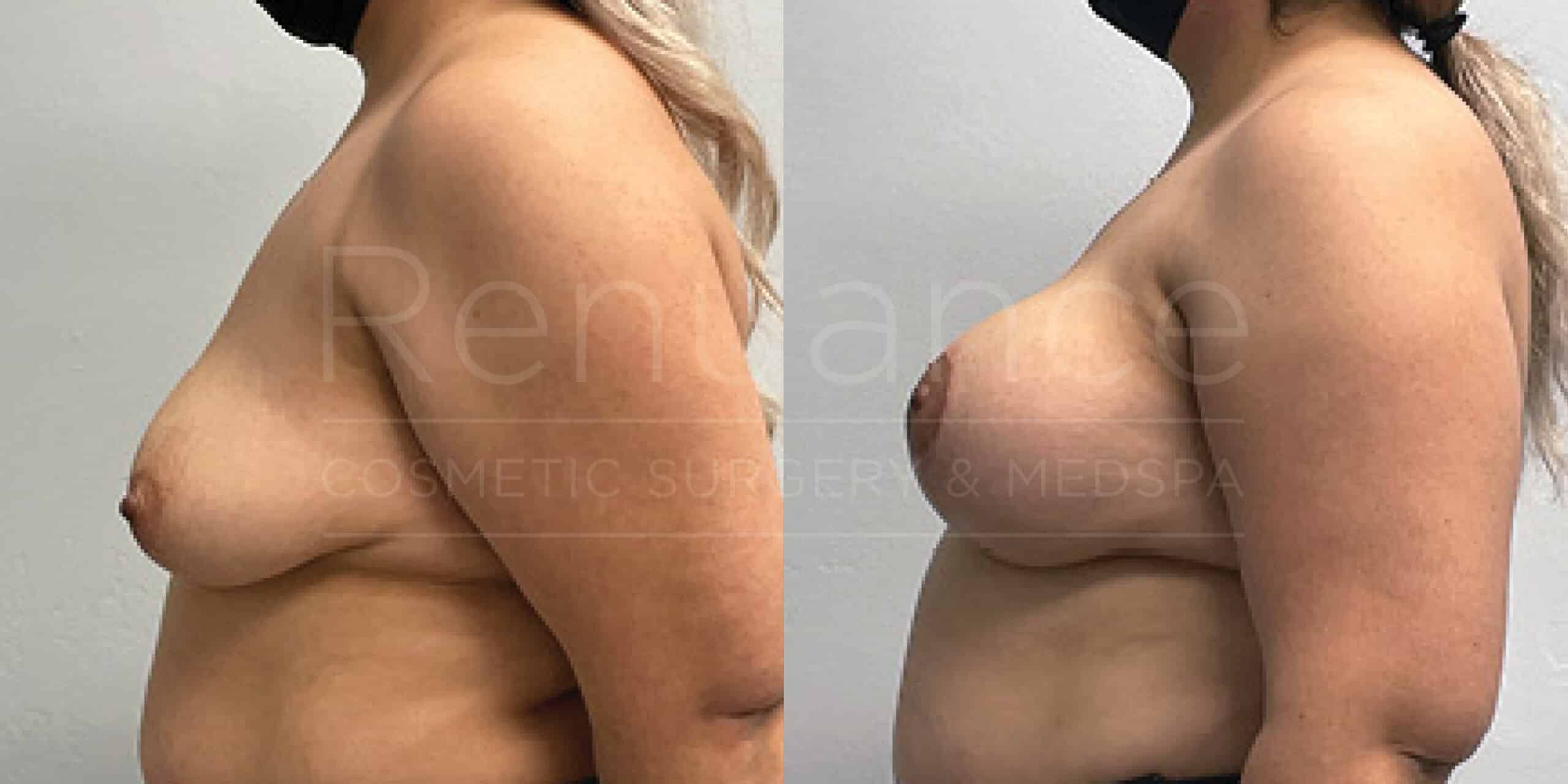 Before/After Breast Lift