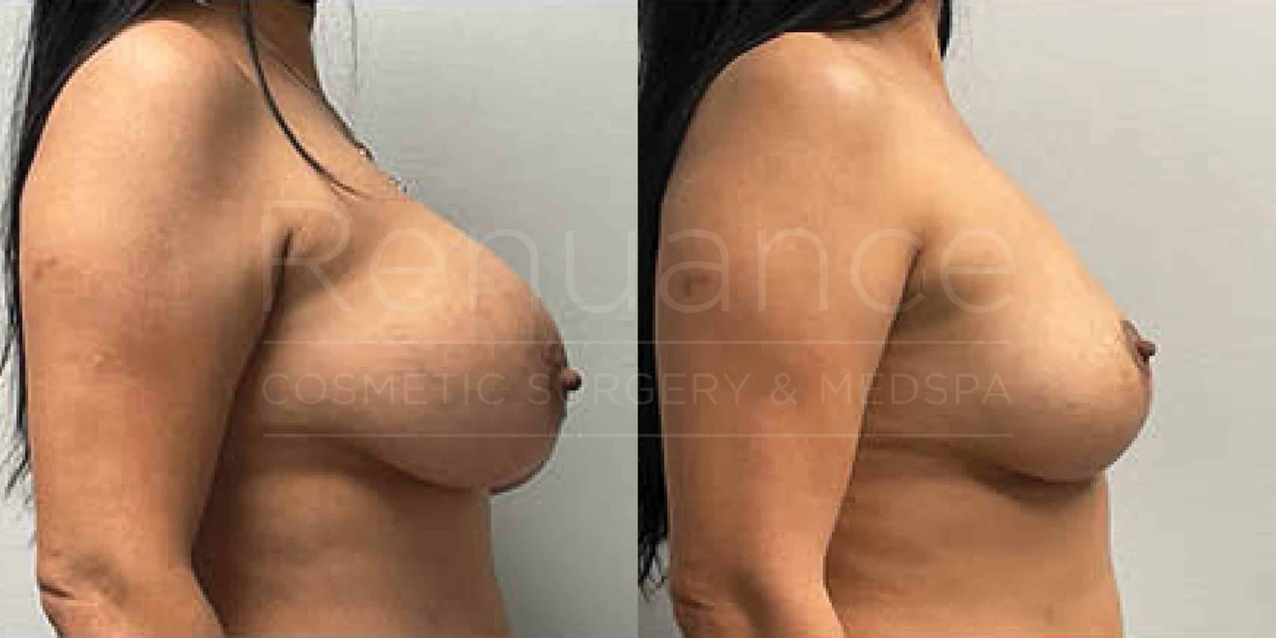 Before/After Breast Lift