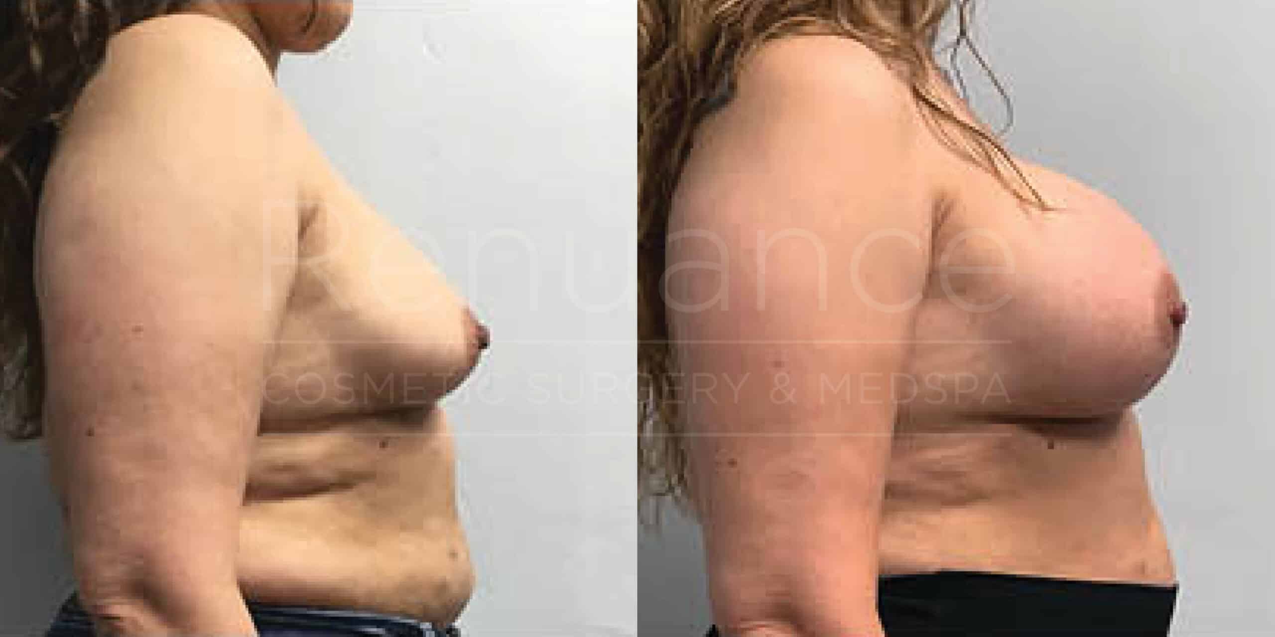 Before/After Breast Augmentation