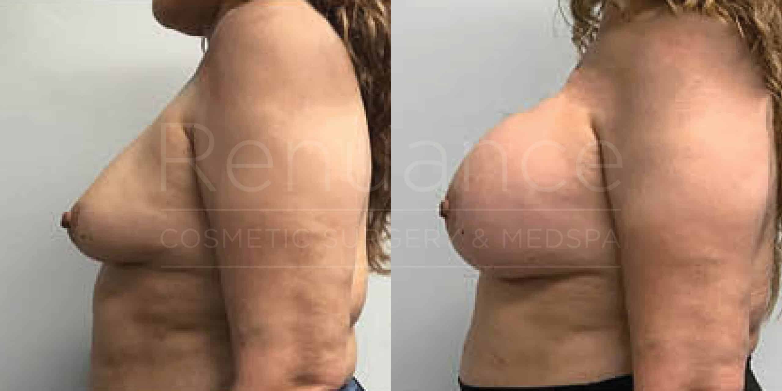 Before/After Breast Augmentation