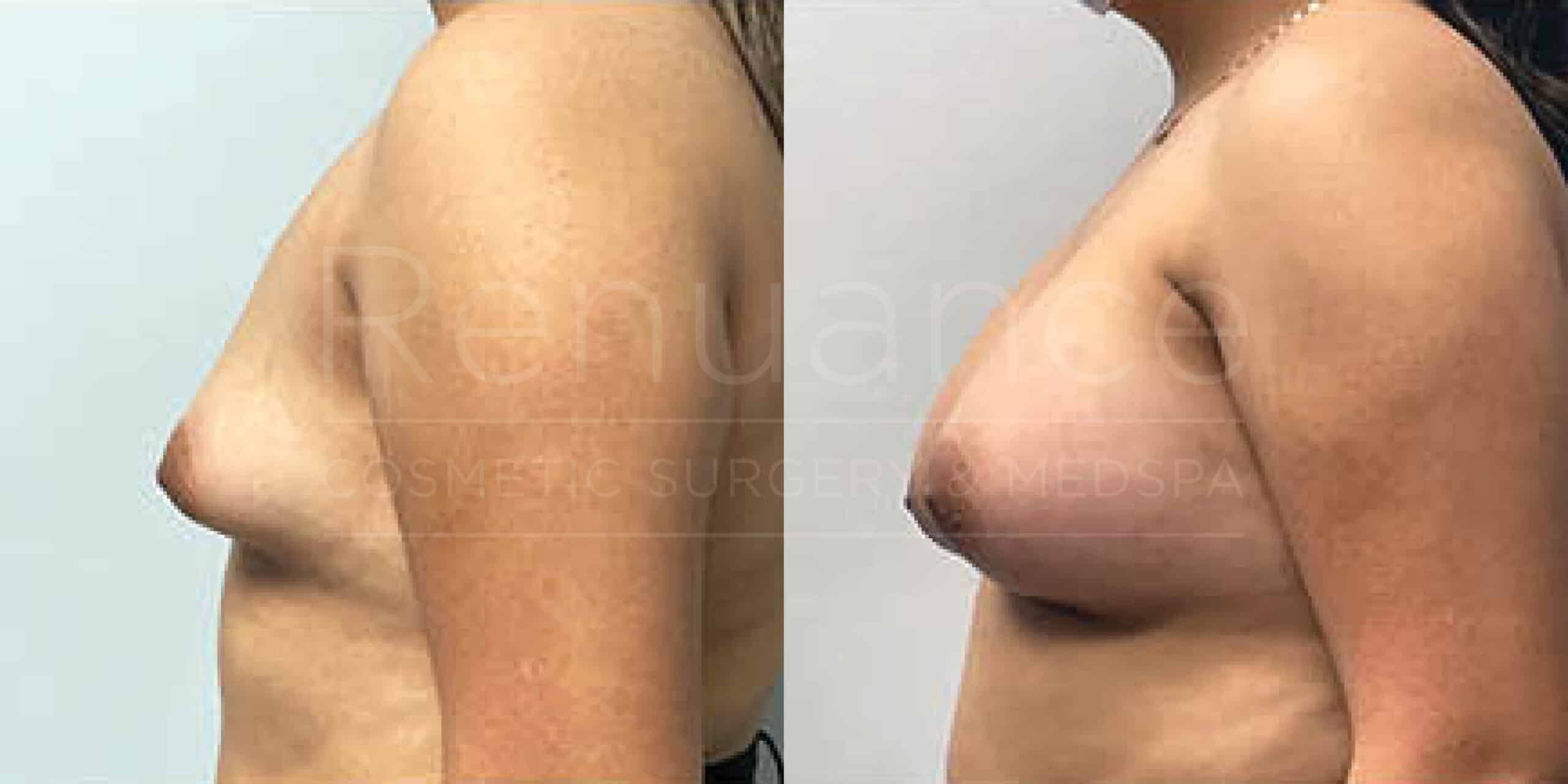 Before/After Breast Augmentation