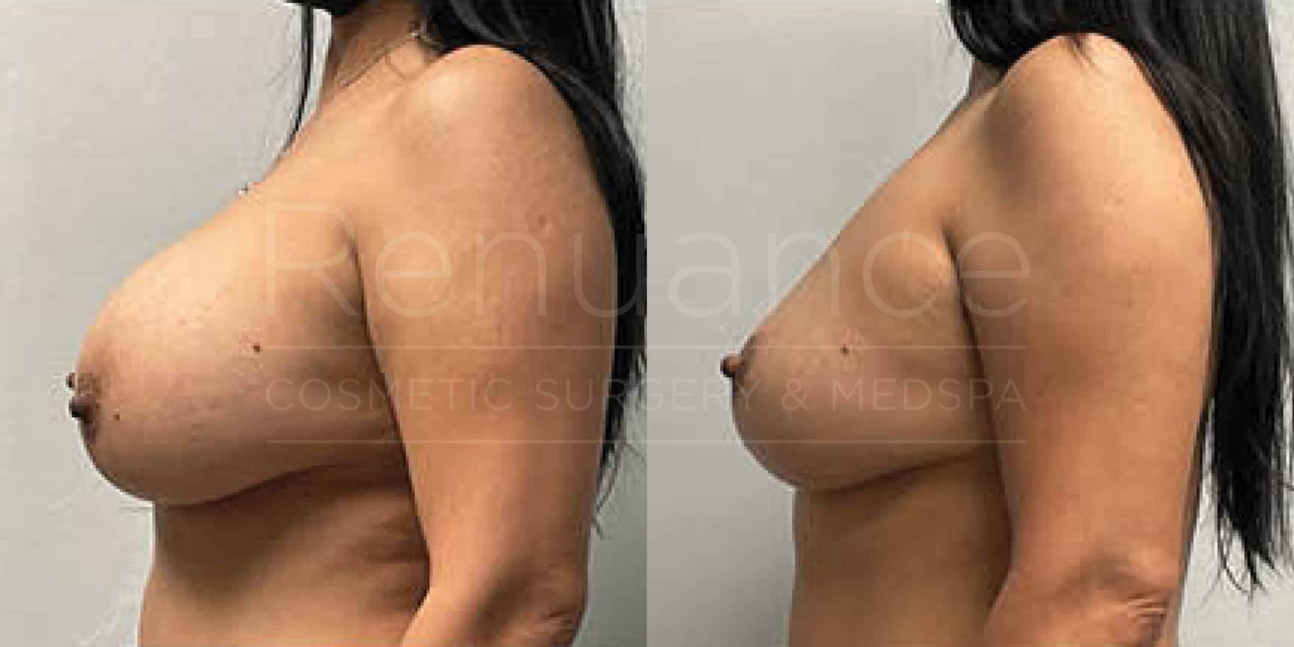Before/After Breast Lift
