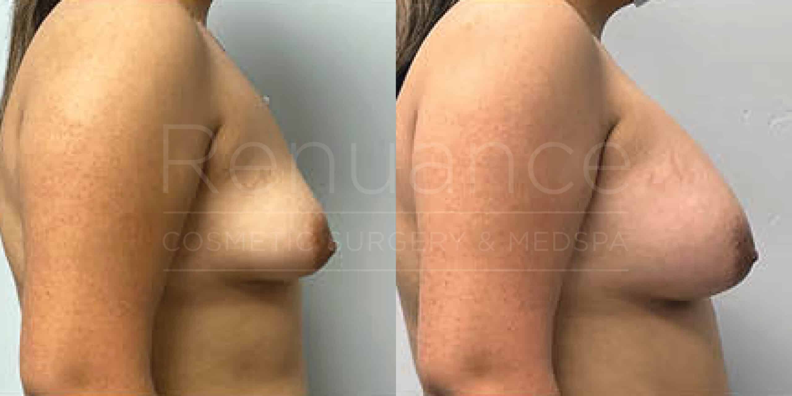 Before/After Breast Augmentation