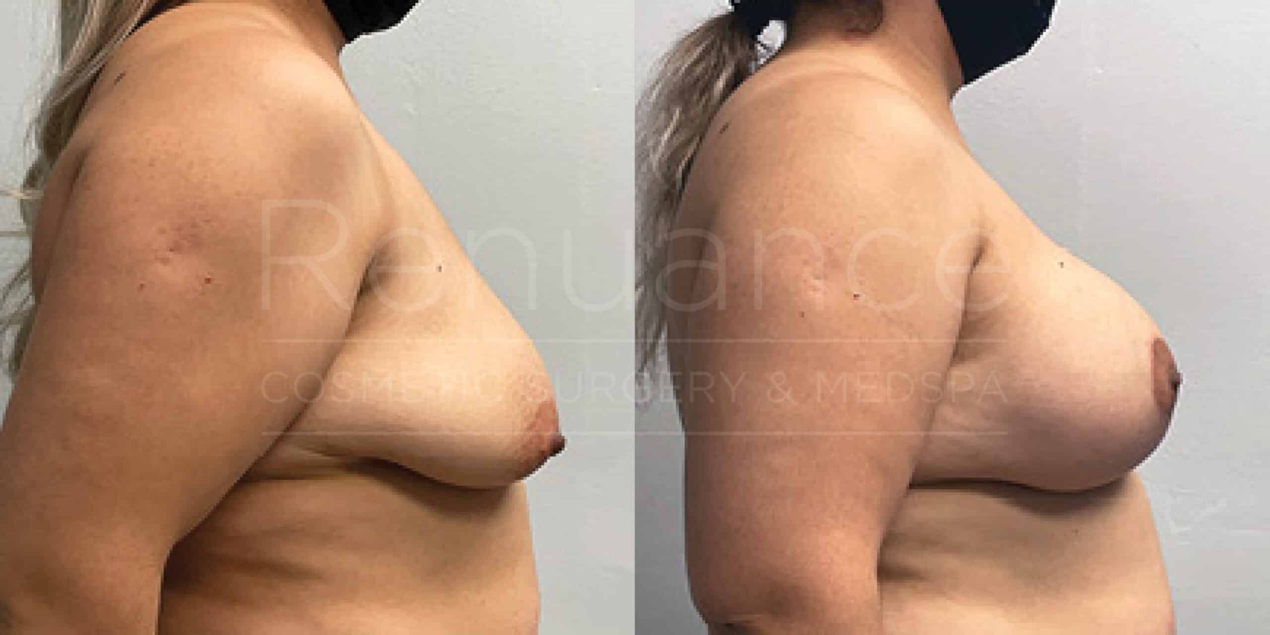 Before/After Breast Lift