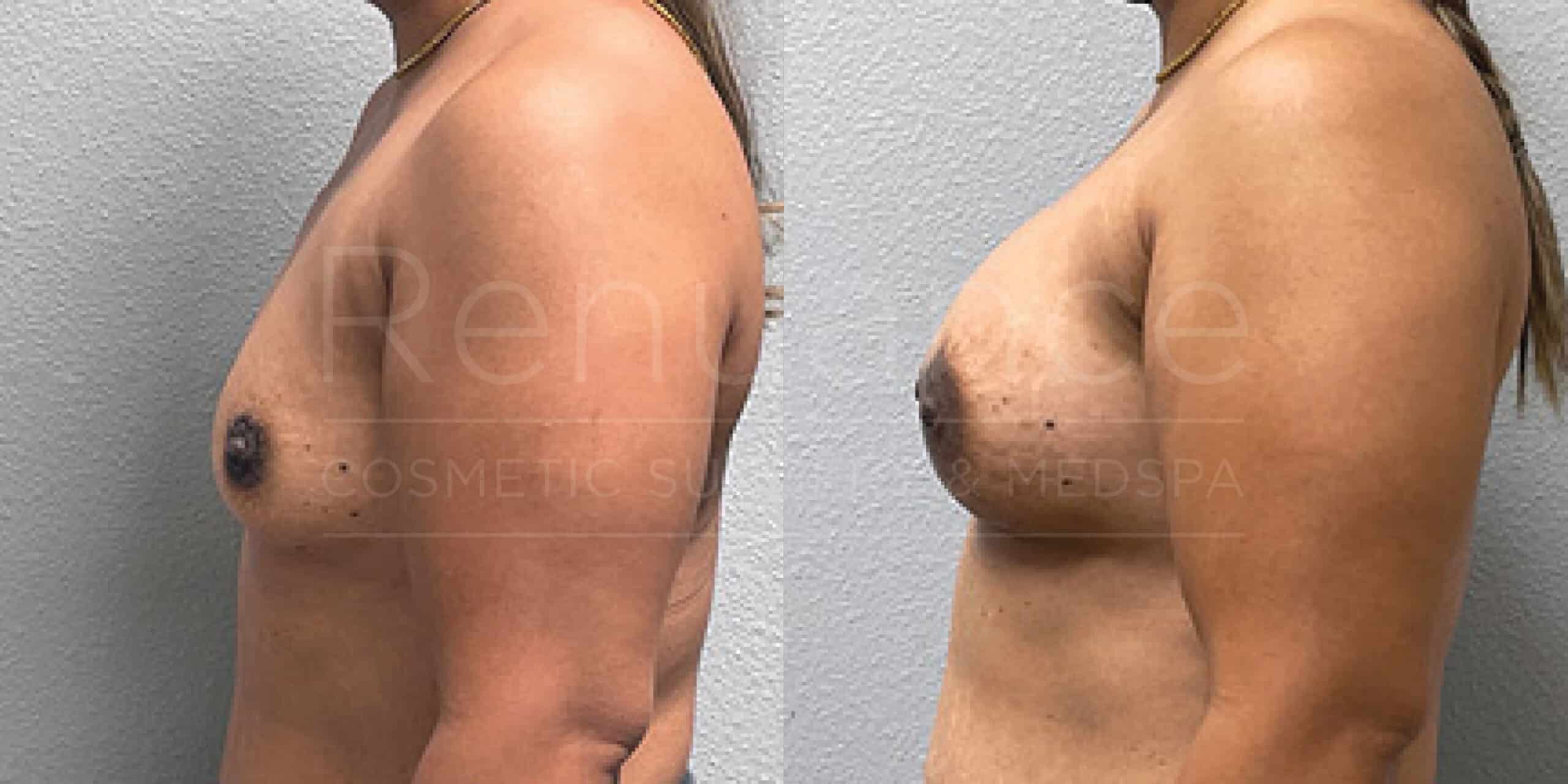 Before/After Breast Augmentation