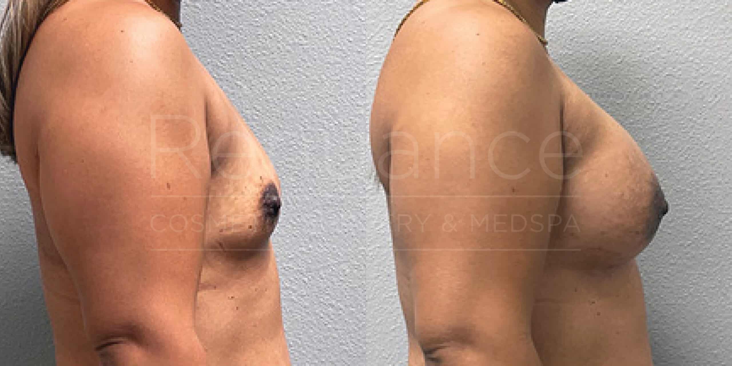 Before/After Breast Augmentation