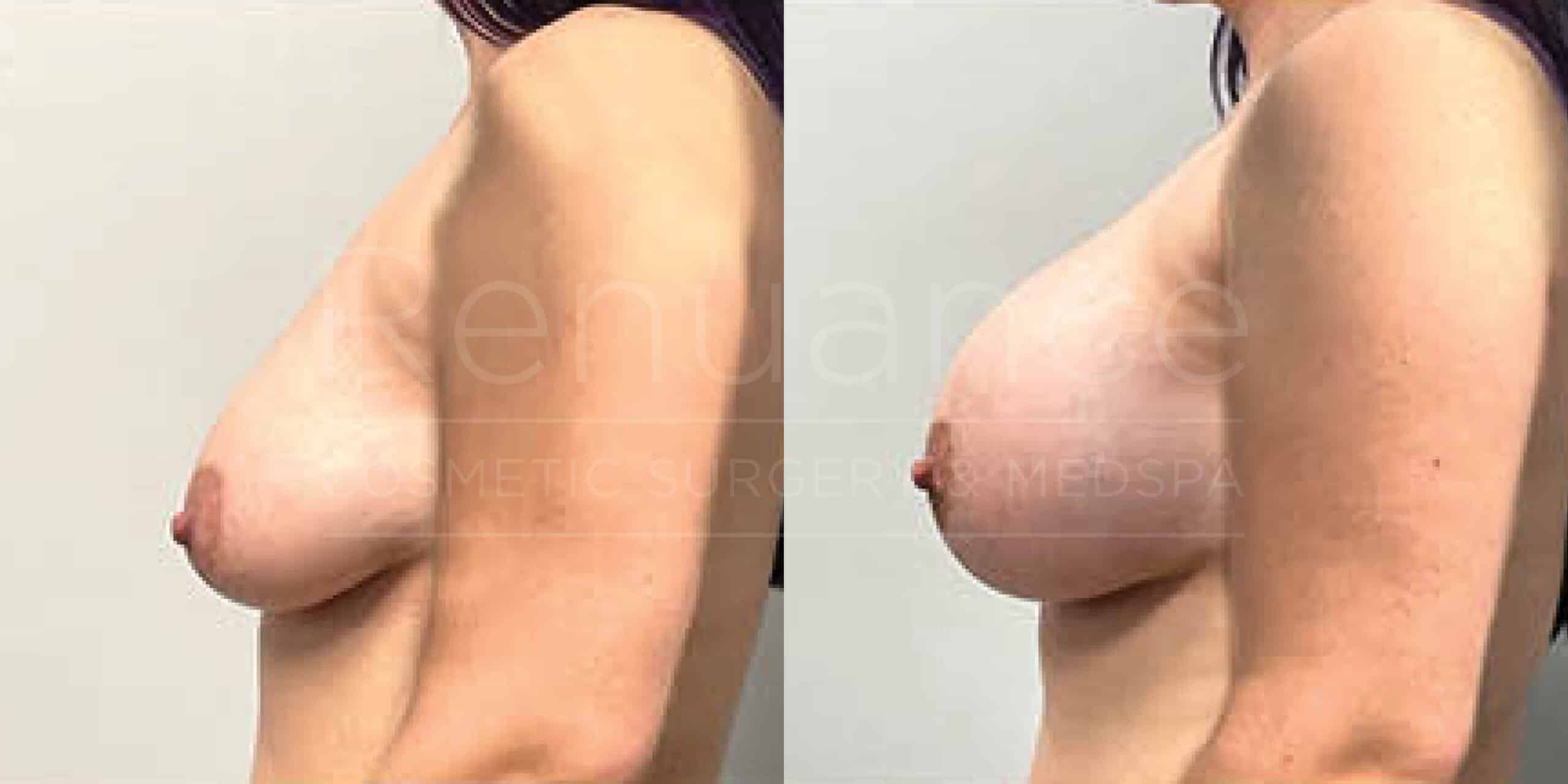 Before/After Breast Augmentation