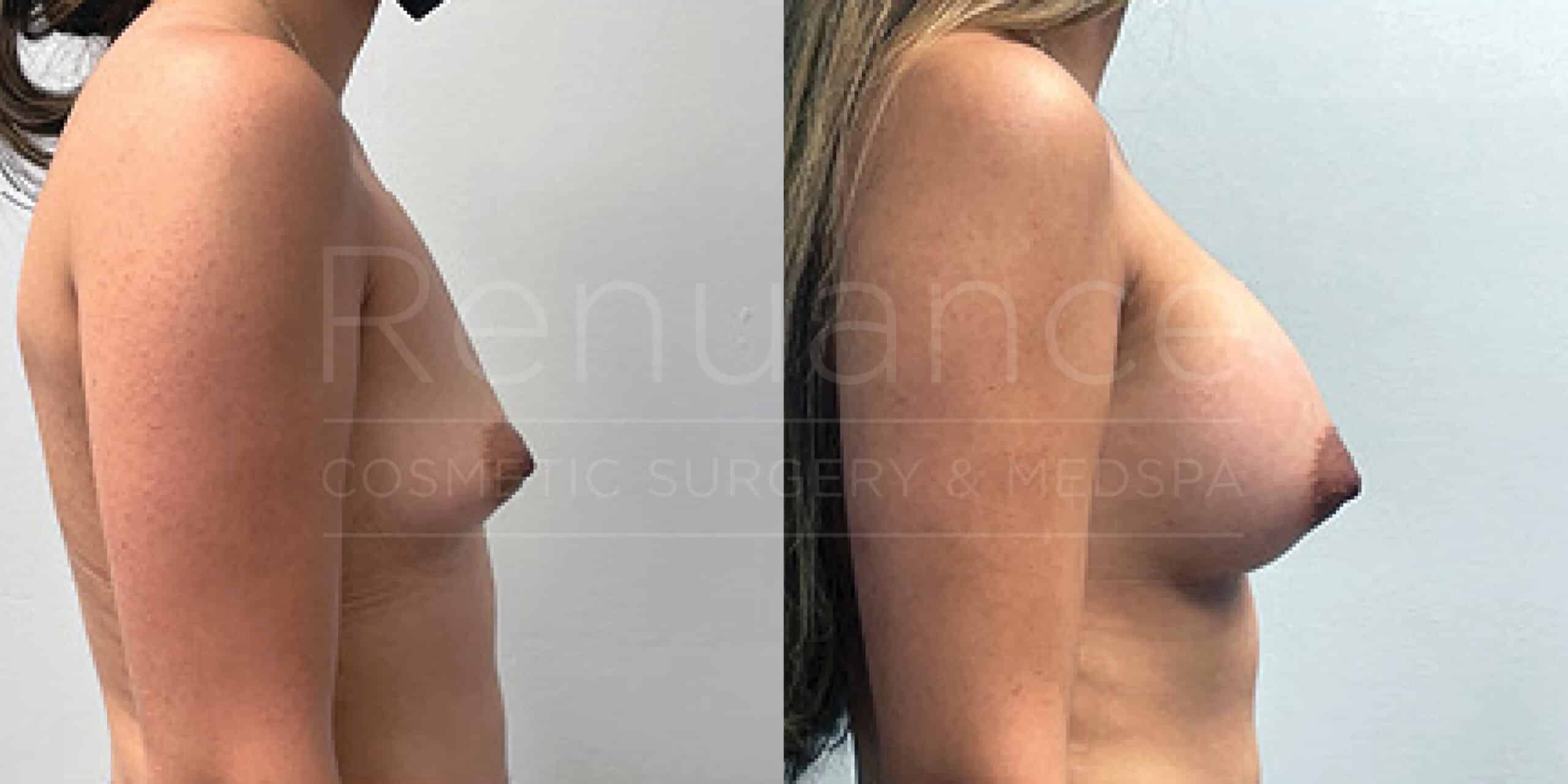 Before/After Breast Augmentation