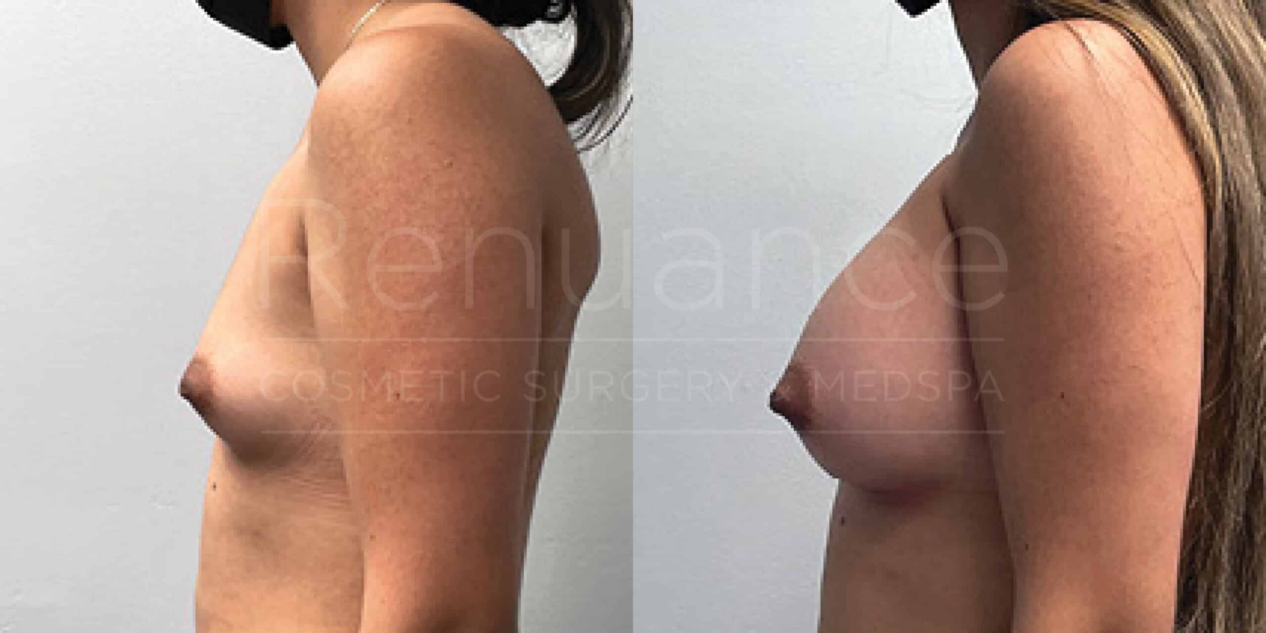 Before/After Breast Augmentation