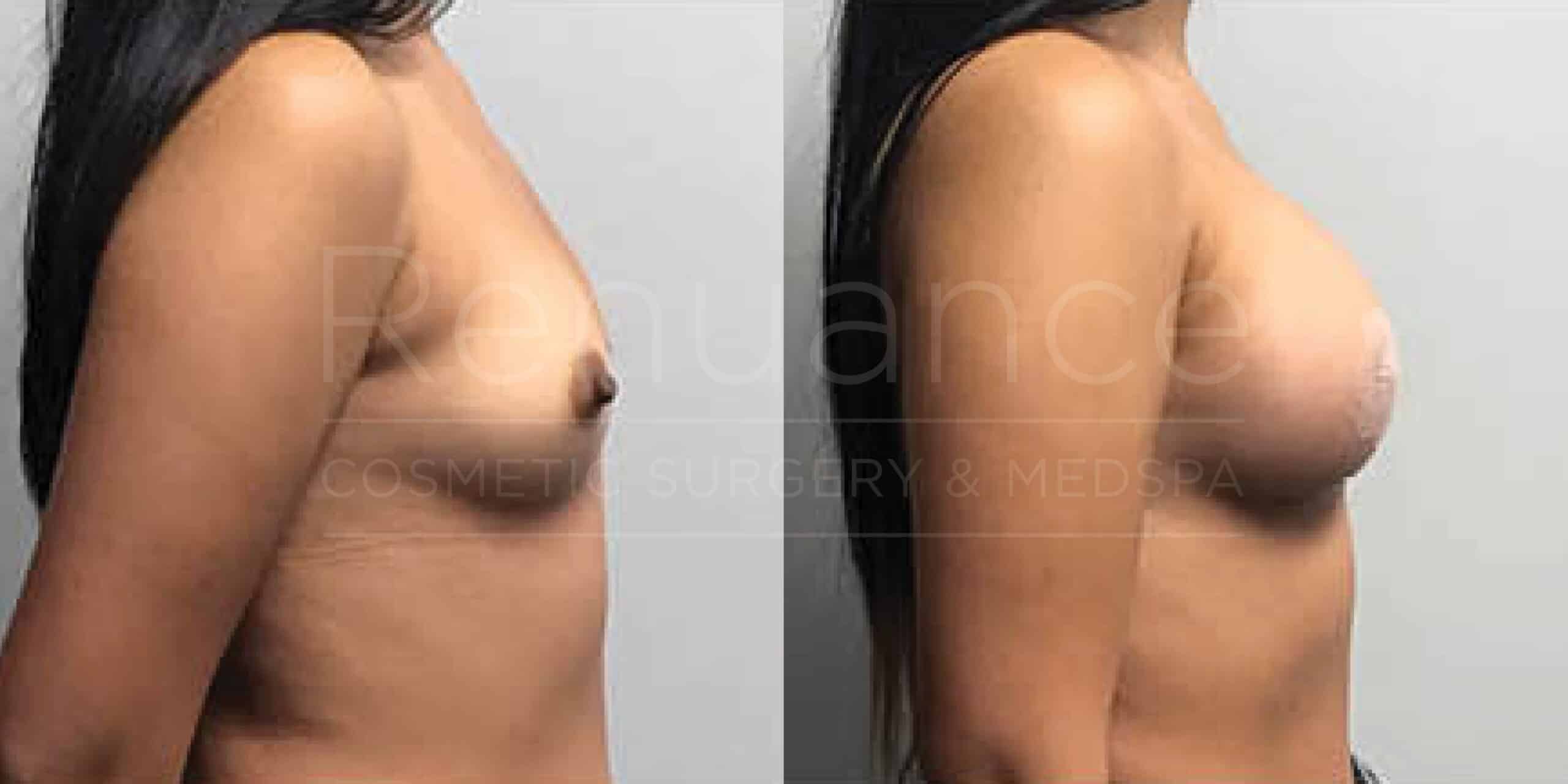 Before/After Breast Augmentation
