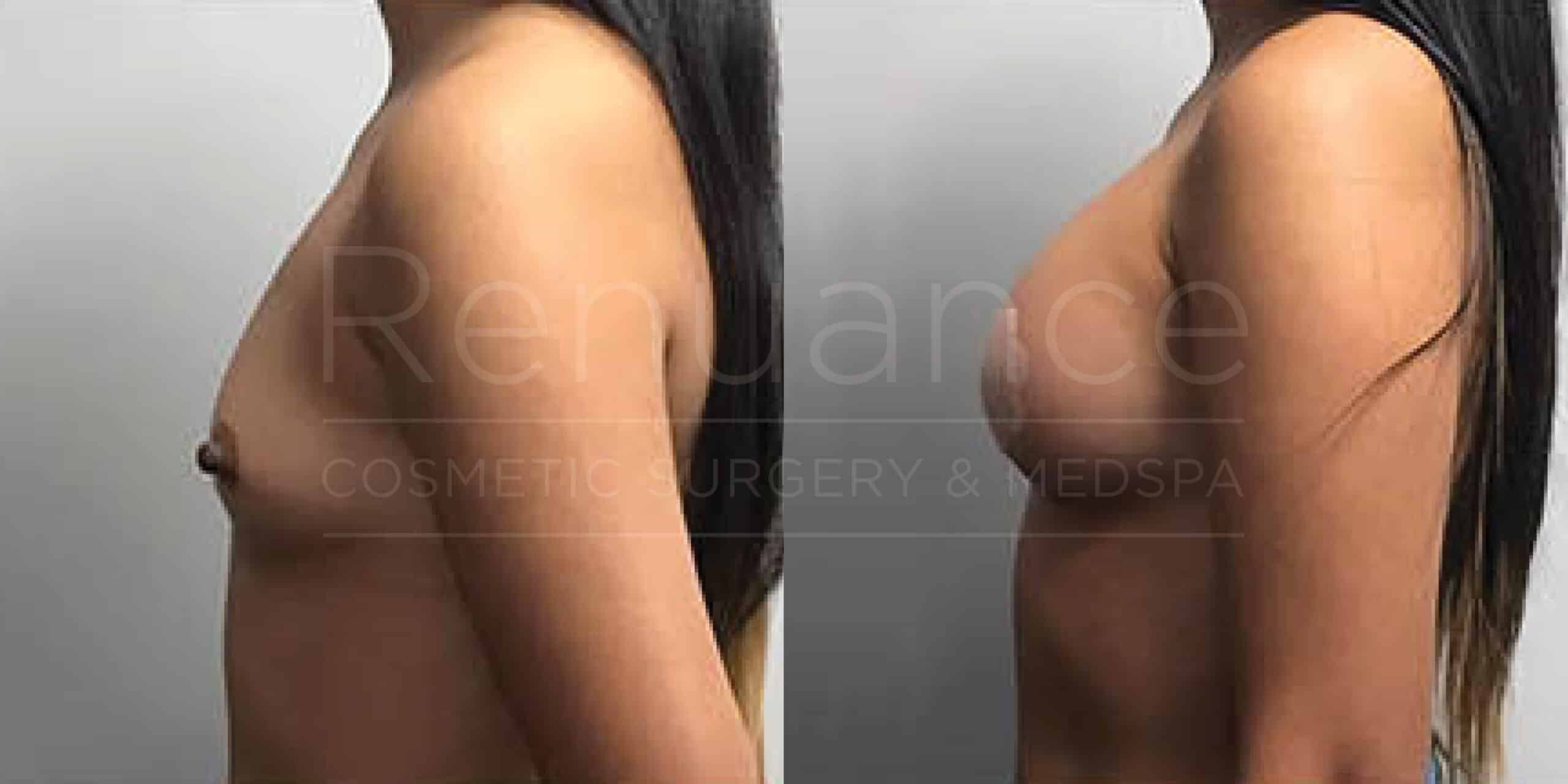 Before/After Breast Augmentation