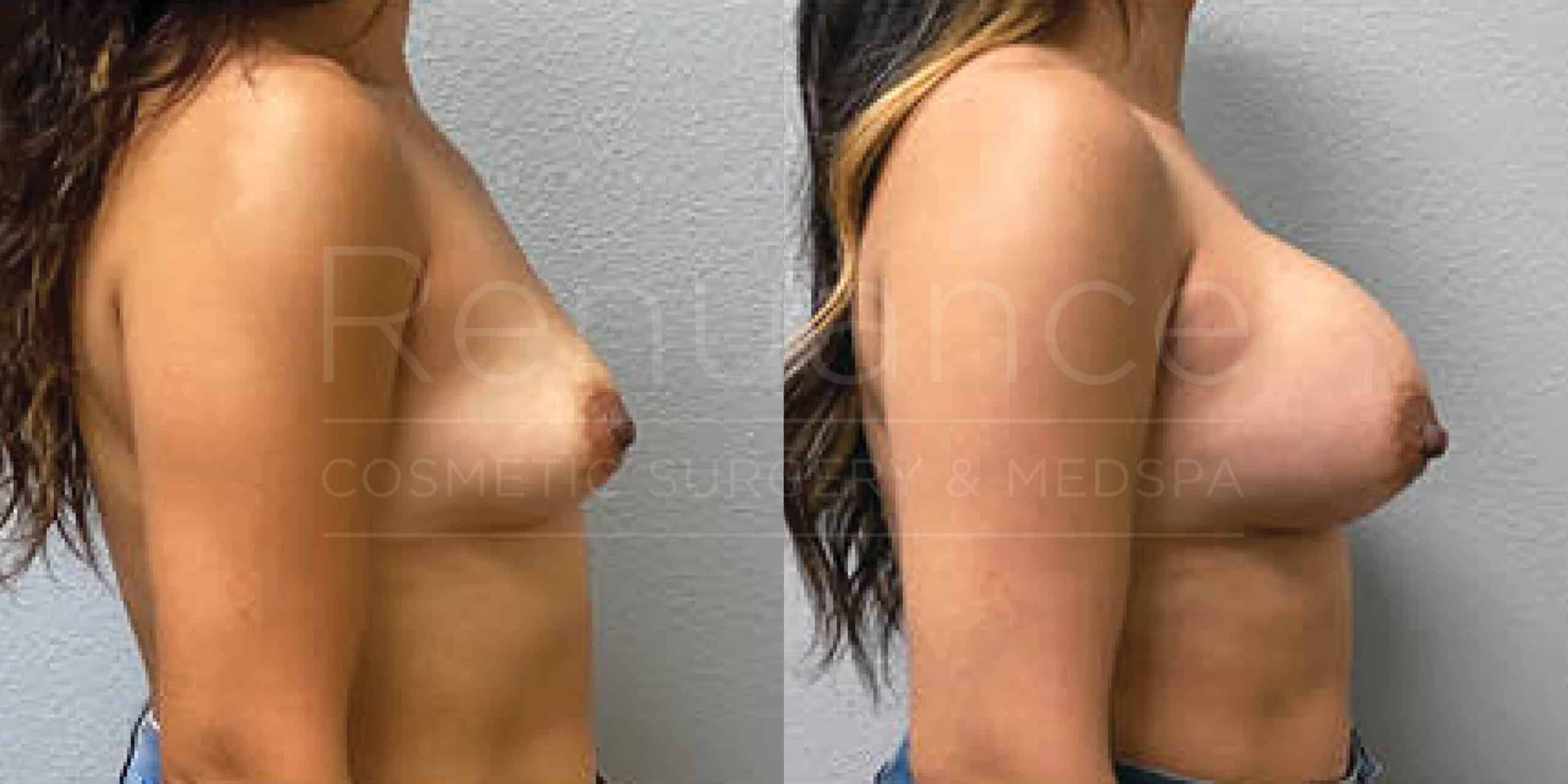 Before/After Breast Augmentation