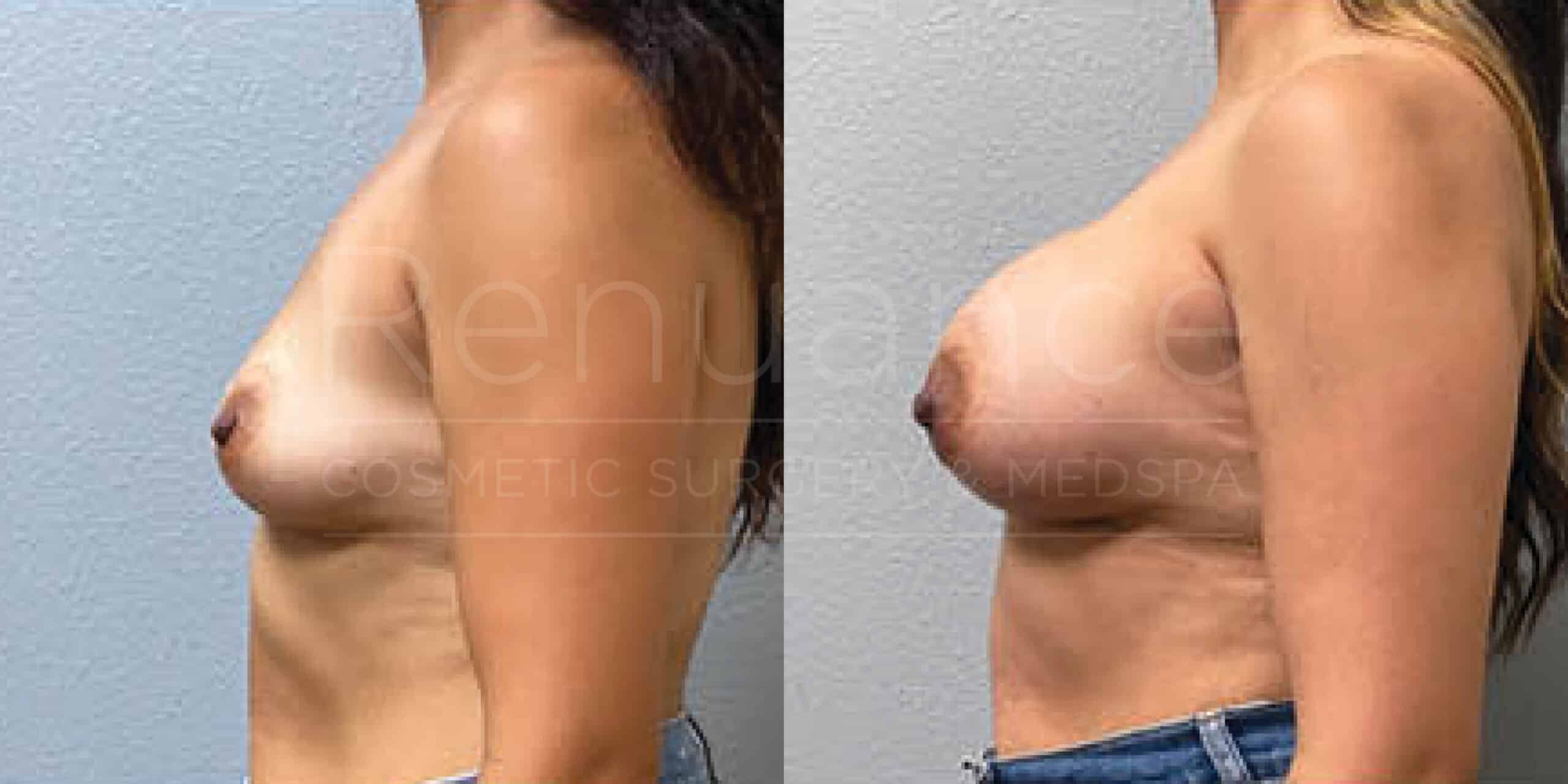 Before/After Breast Augmentation