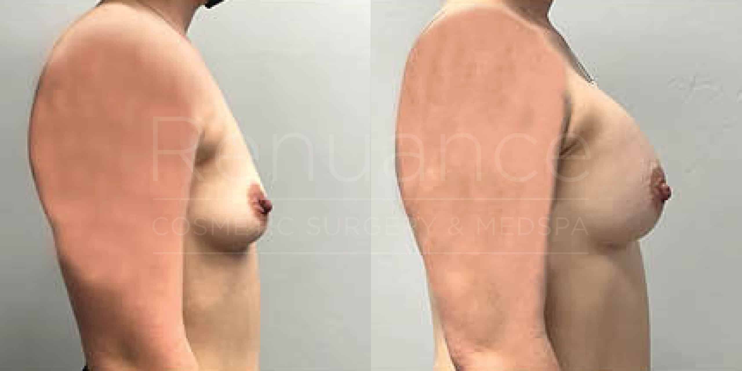 Before/After Breast Augmentation