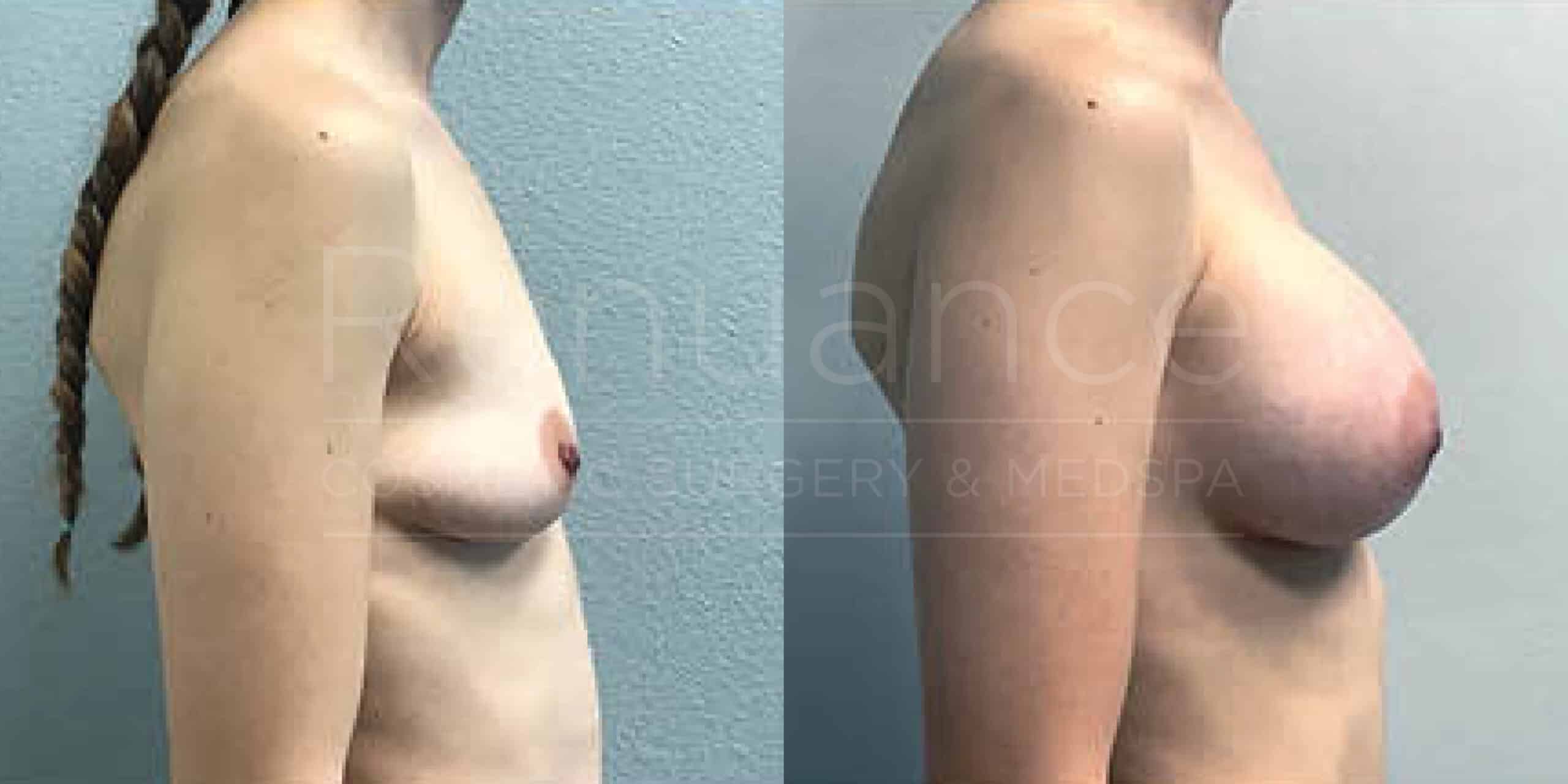 Before/After Breast Augmentation