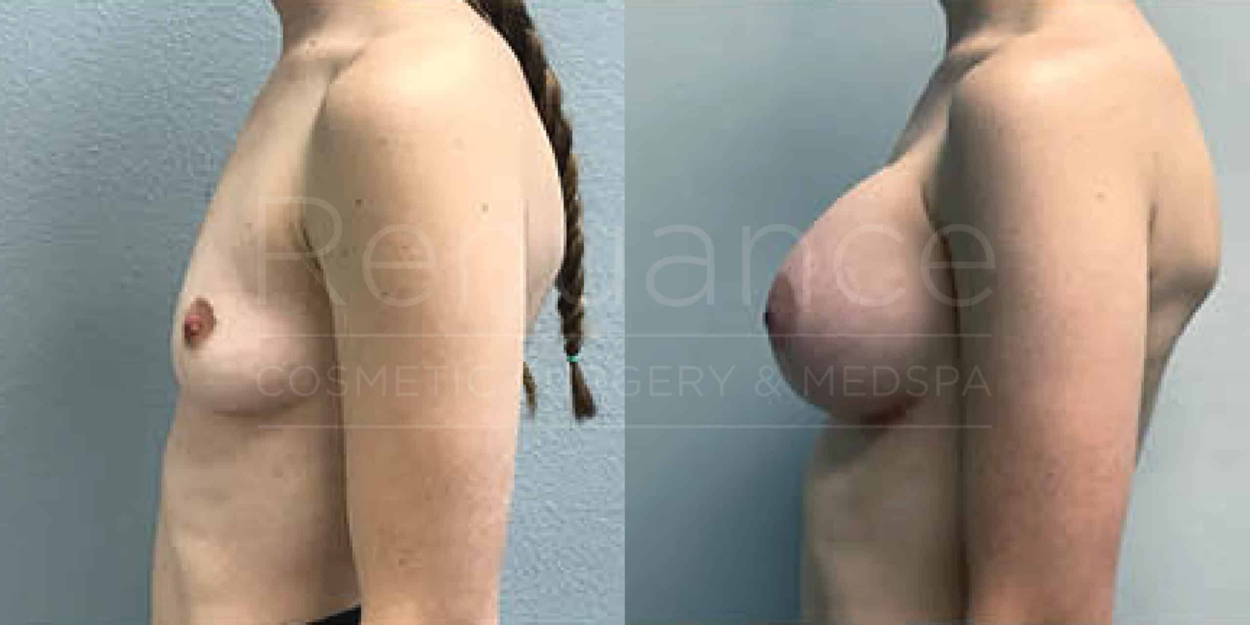 Before/After Breast Augmentation