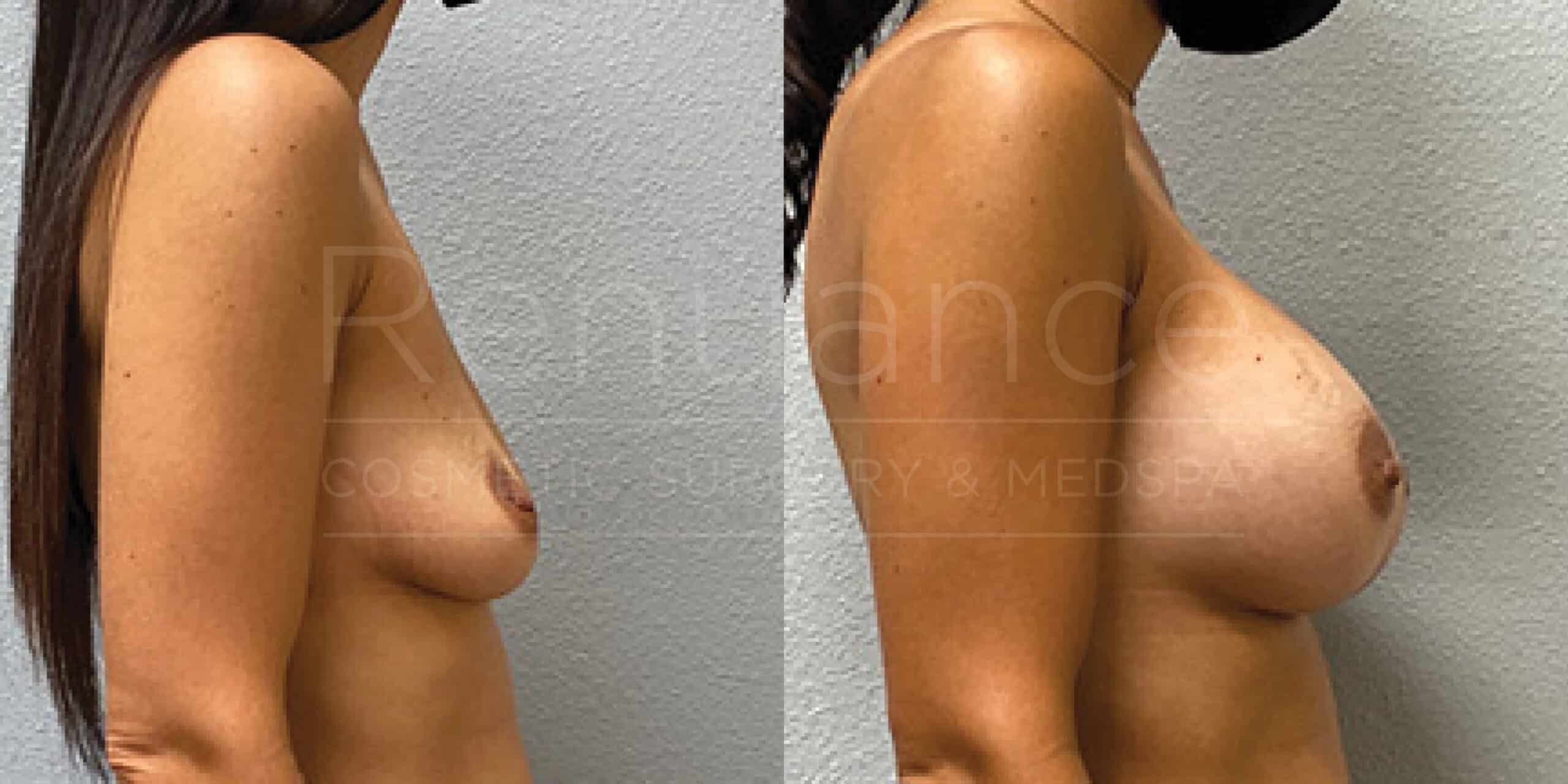 Before/After Breast Augmentation
