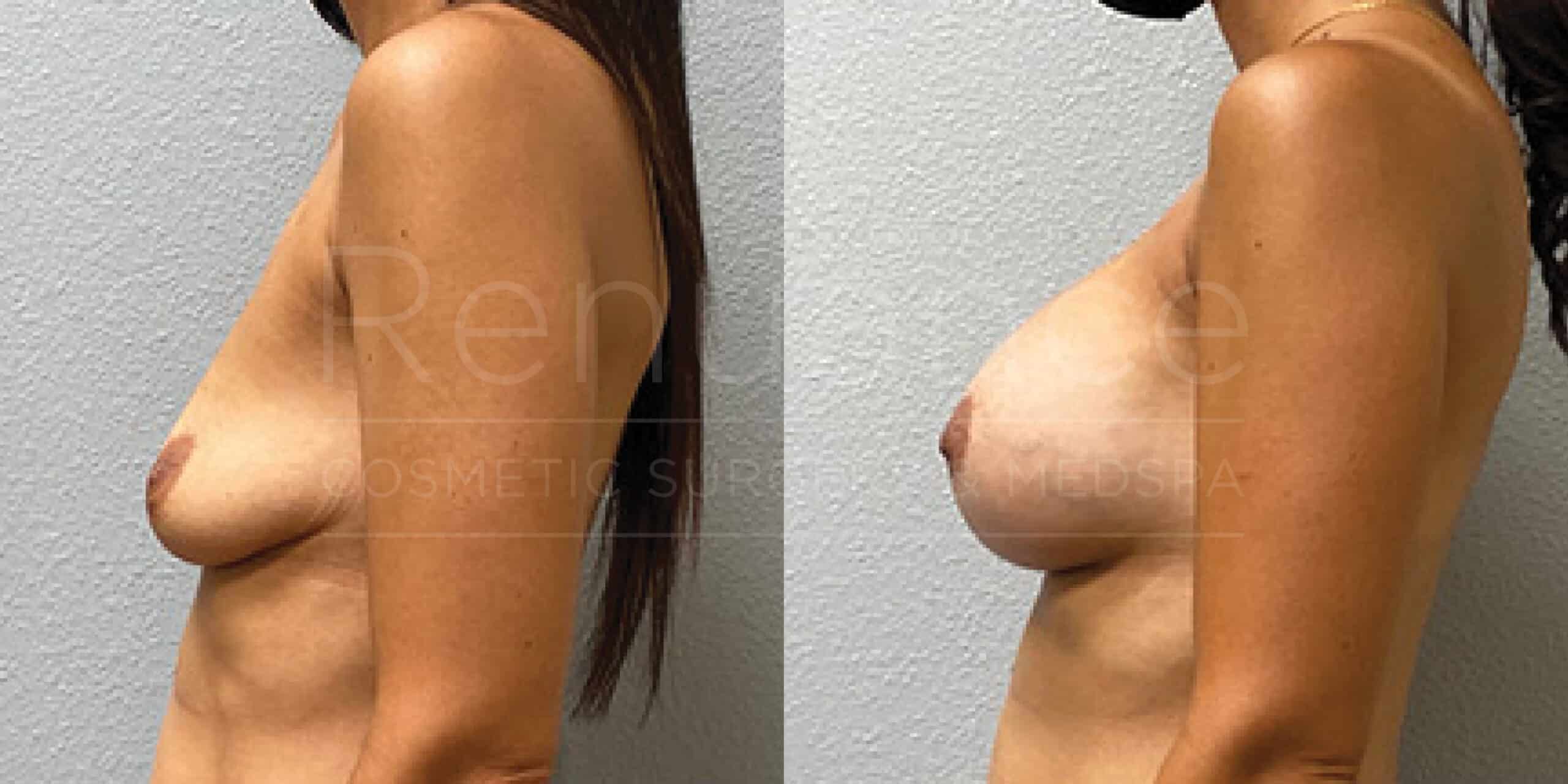 Before/After Breast Augmentation