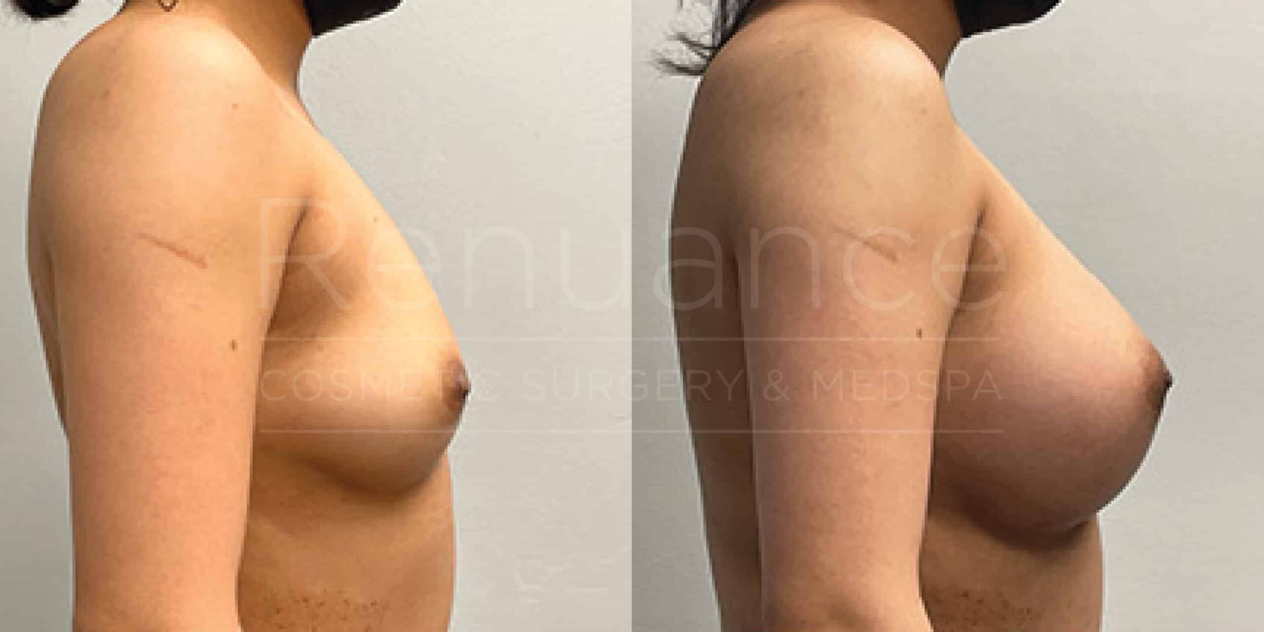 Before/After Breast Augmentation