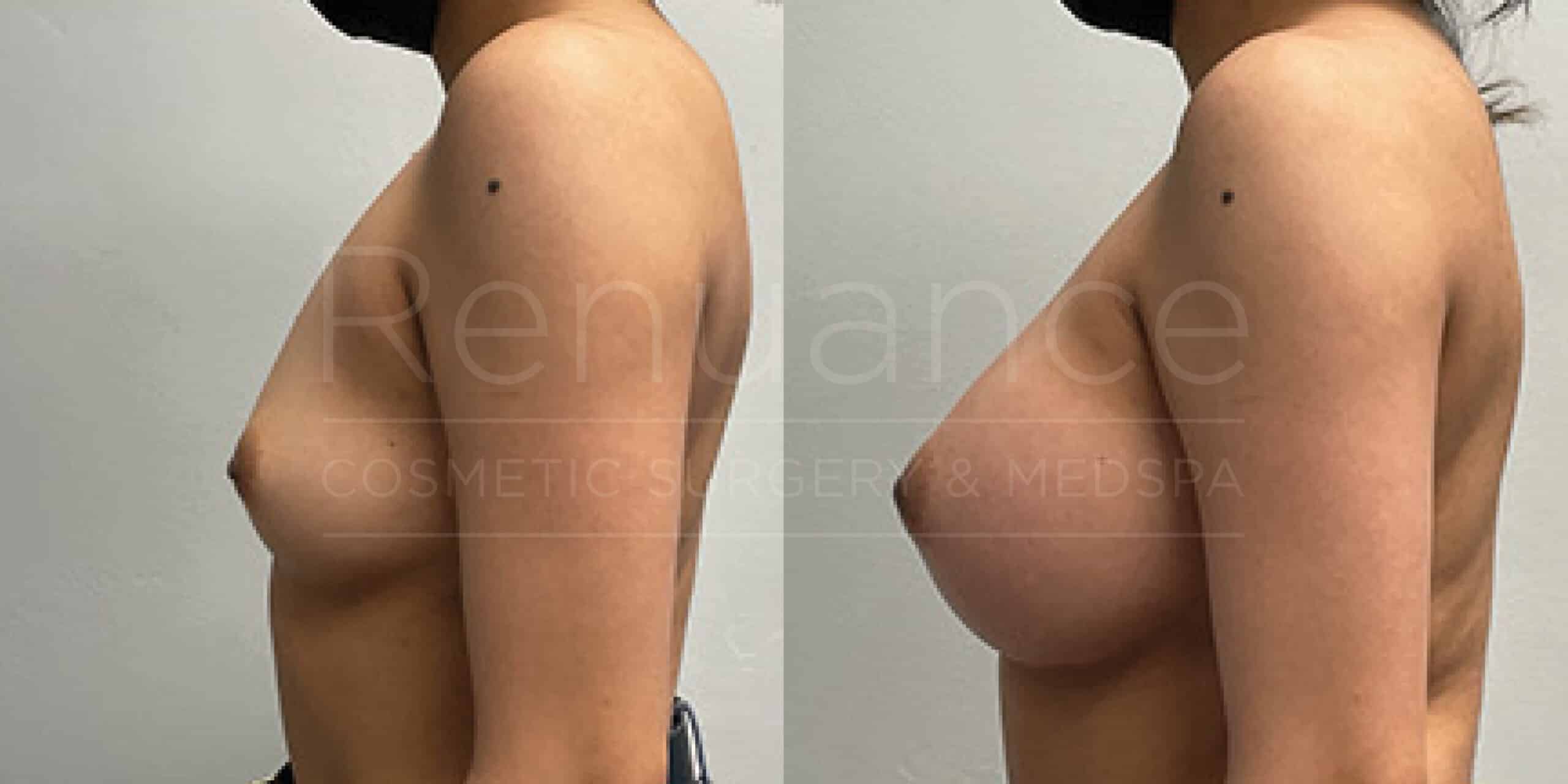 Before/After Breast Augmentation