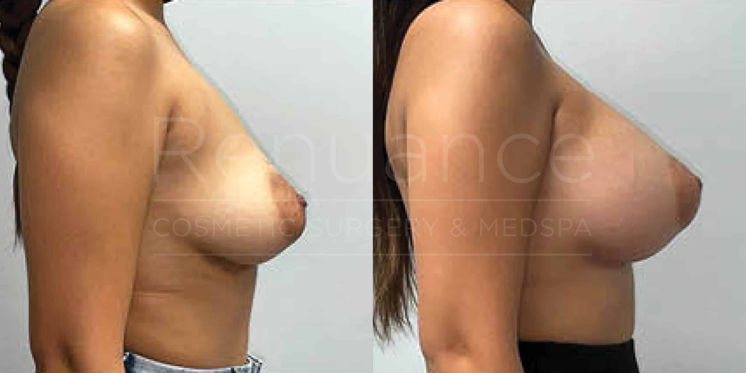 Before/After Breast Augmentation