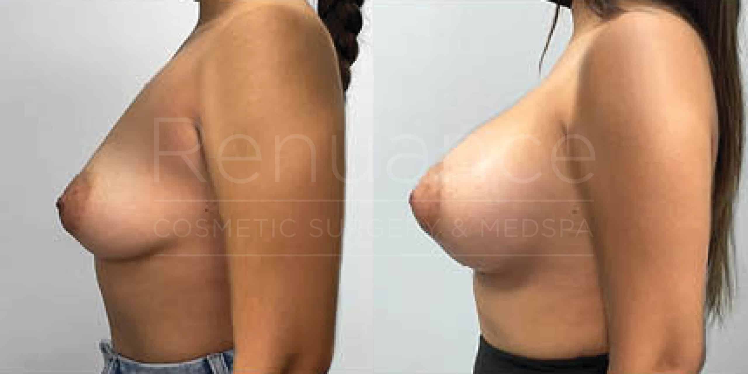Before/After Breast Augmentation