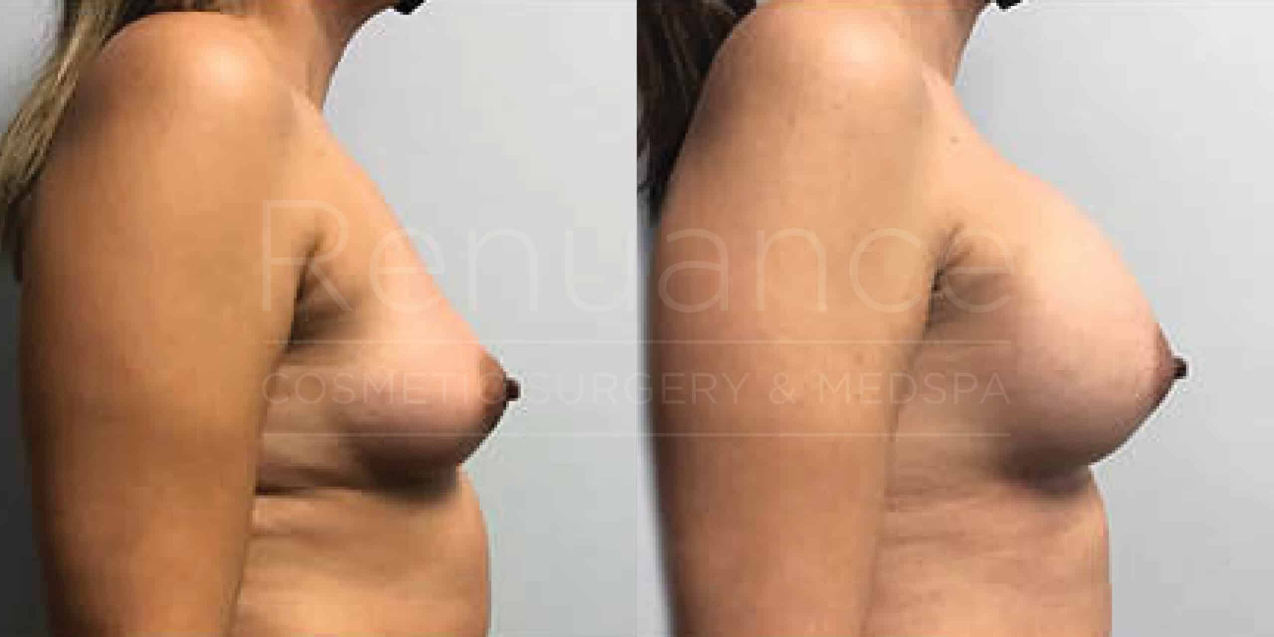 Before/After Breast Augmentation