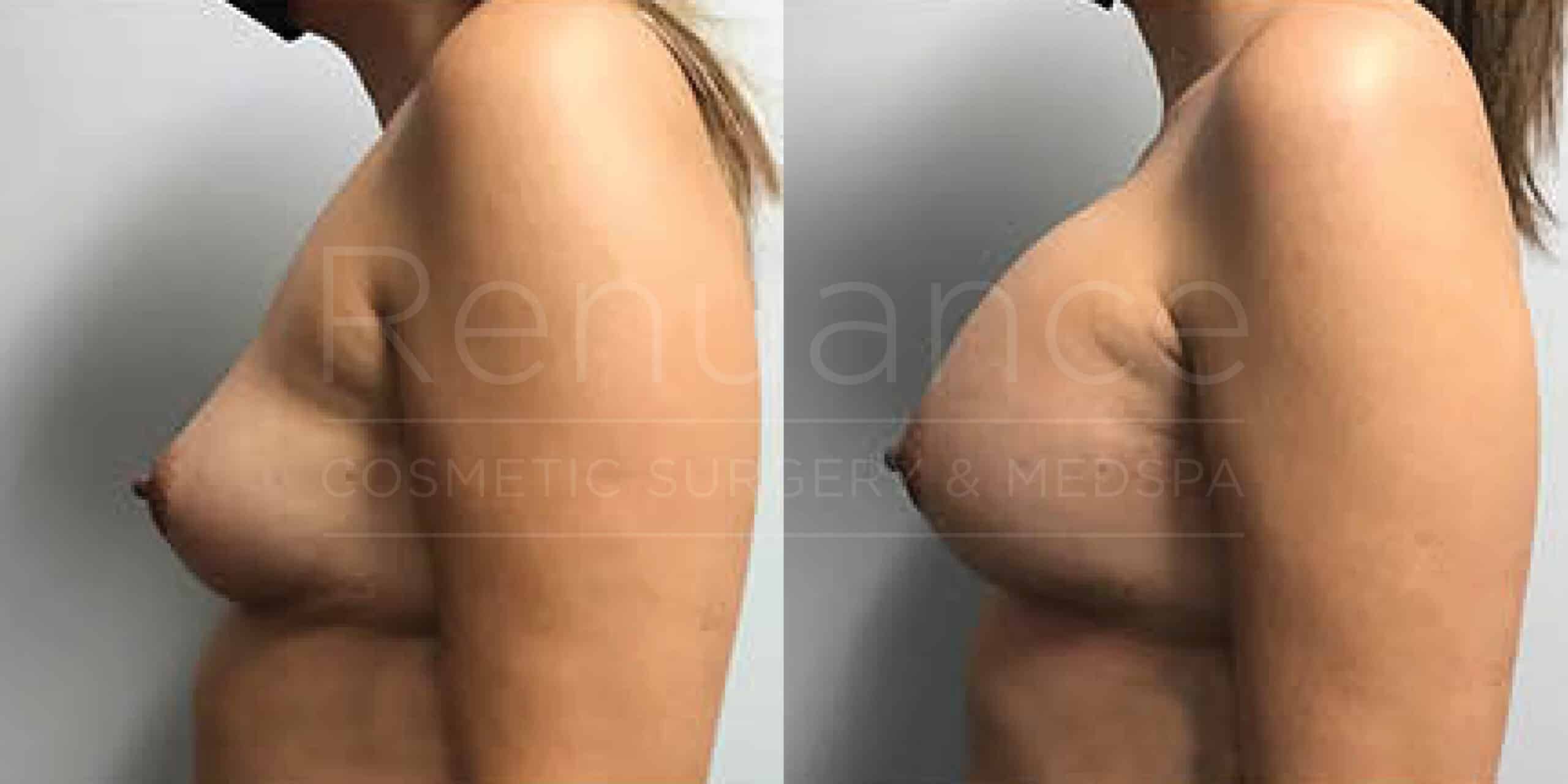 Before/After Breast Augmentation