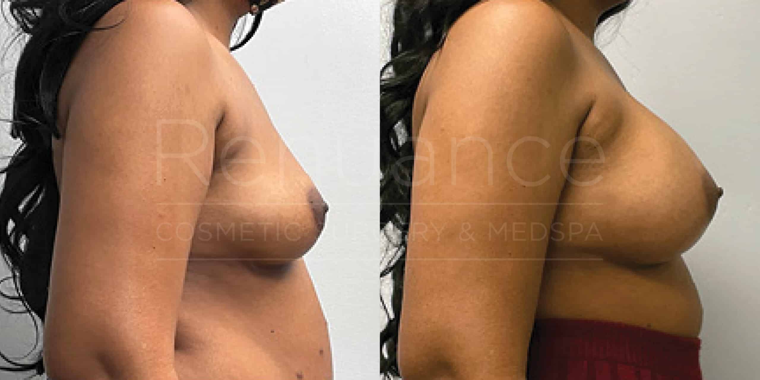 Before/After Breast Augmentation