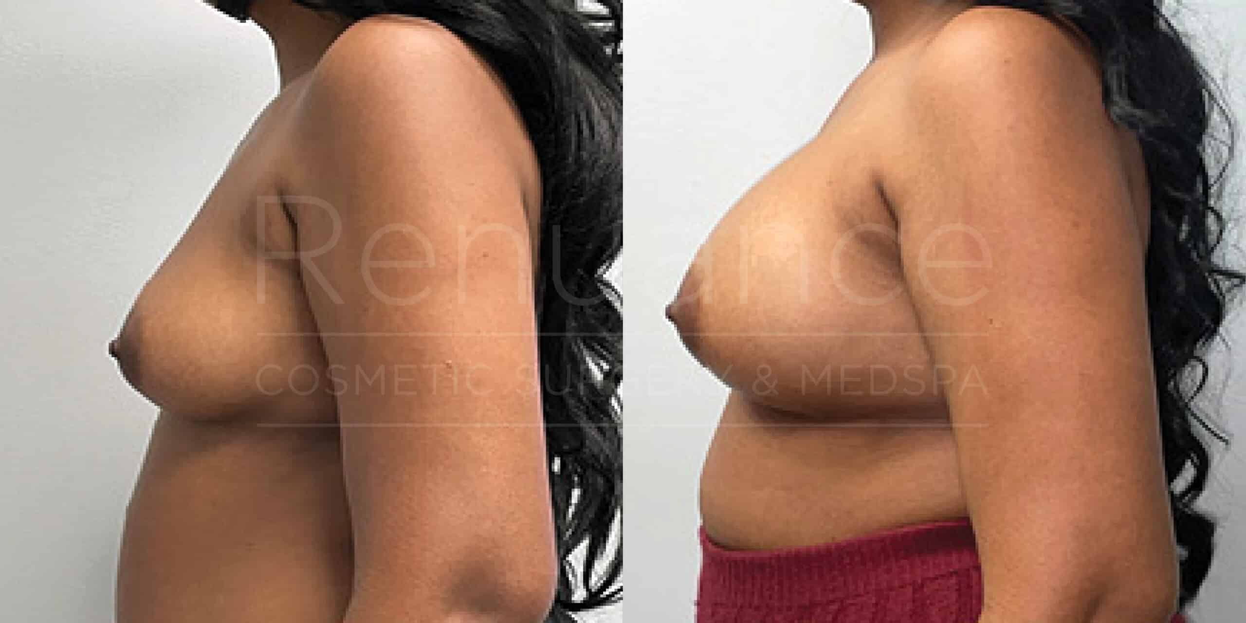 Before/After Breast Augmentation