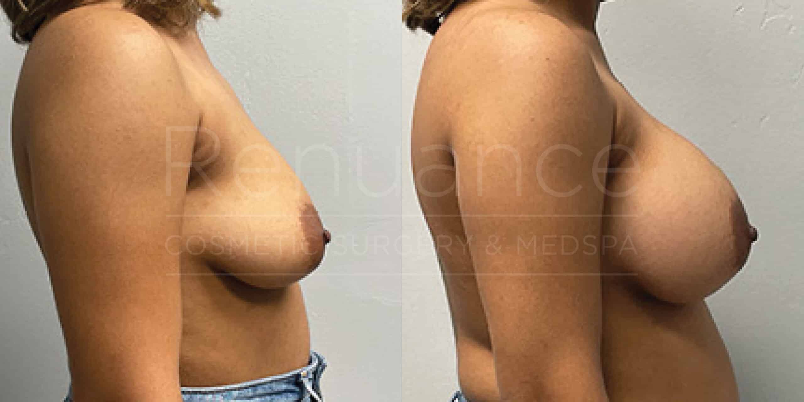 Before/After Breast Augmentation