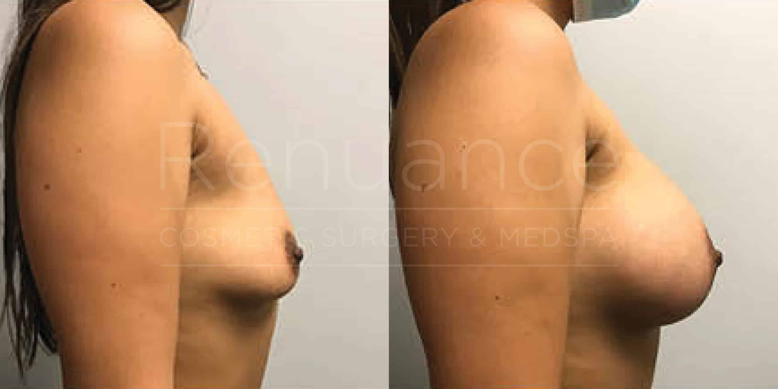 Before/After Breast Augmentation