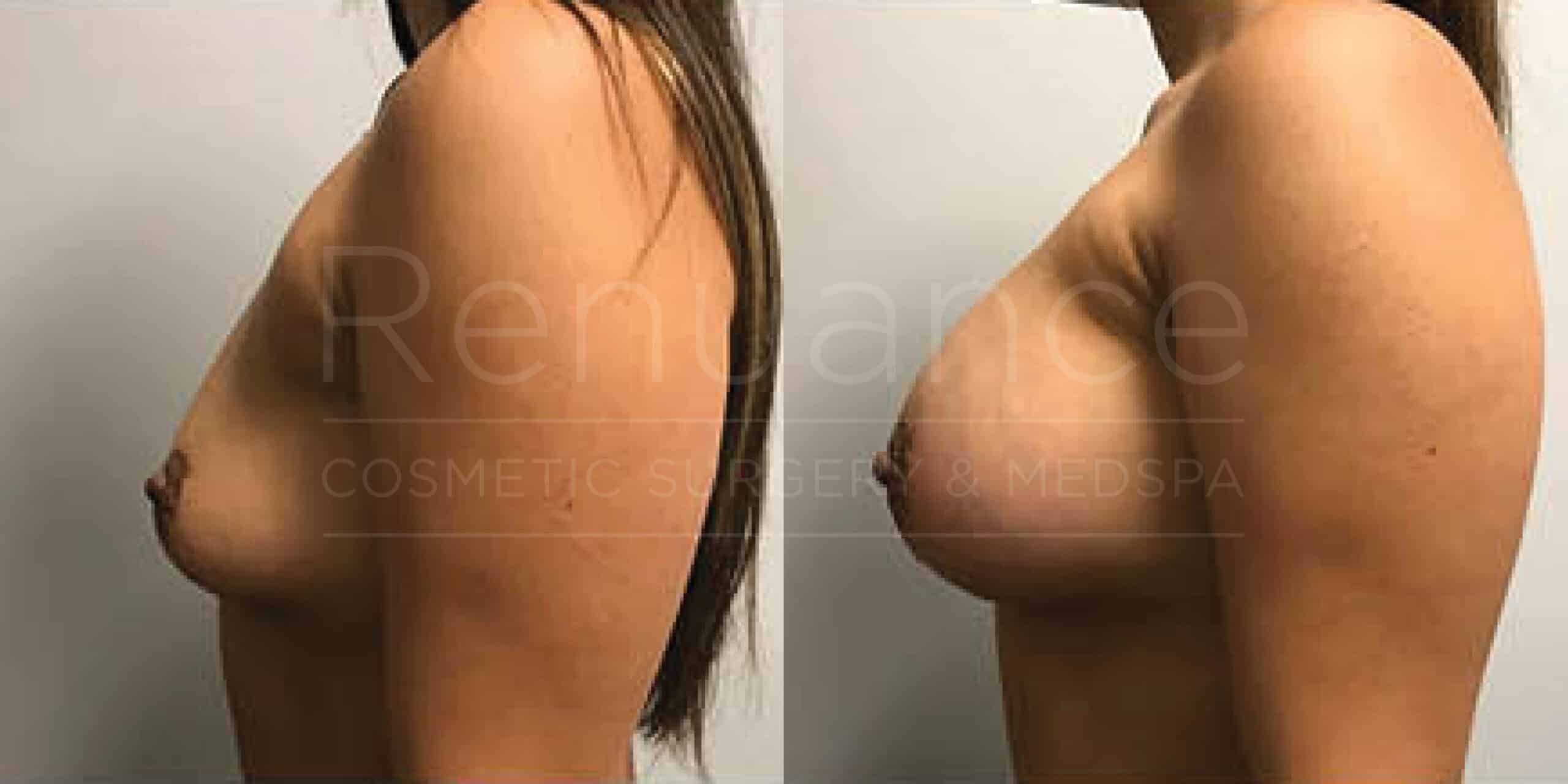 Before/After Breast Augmentation