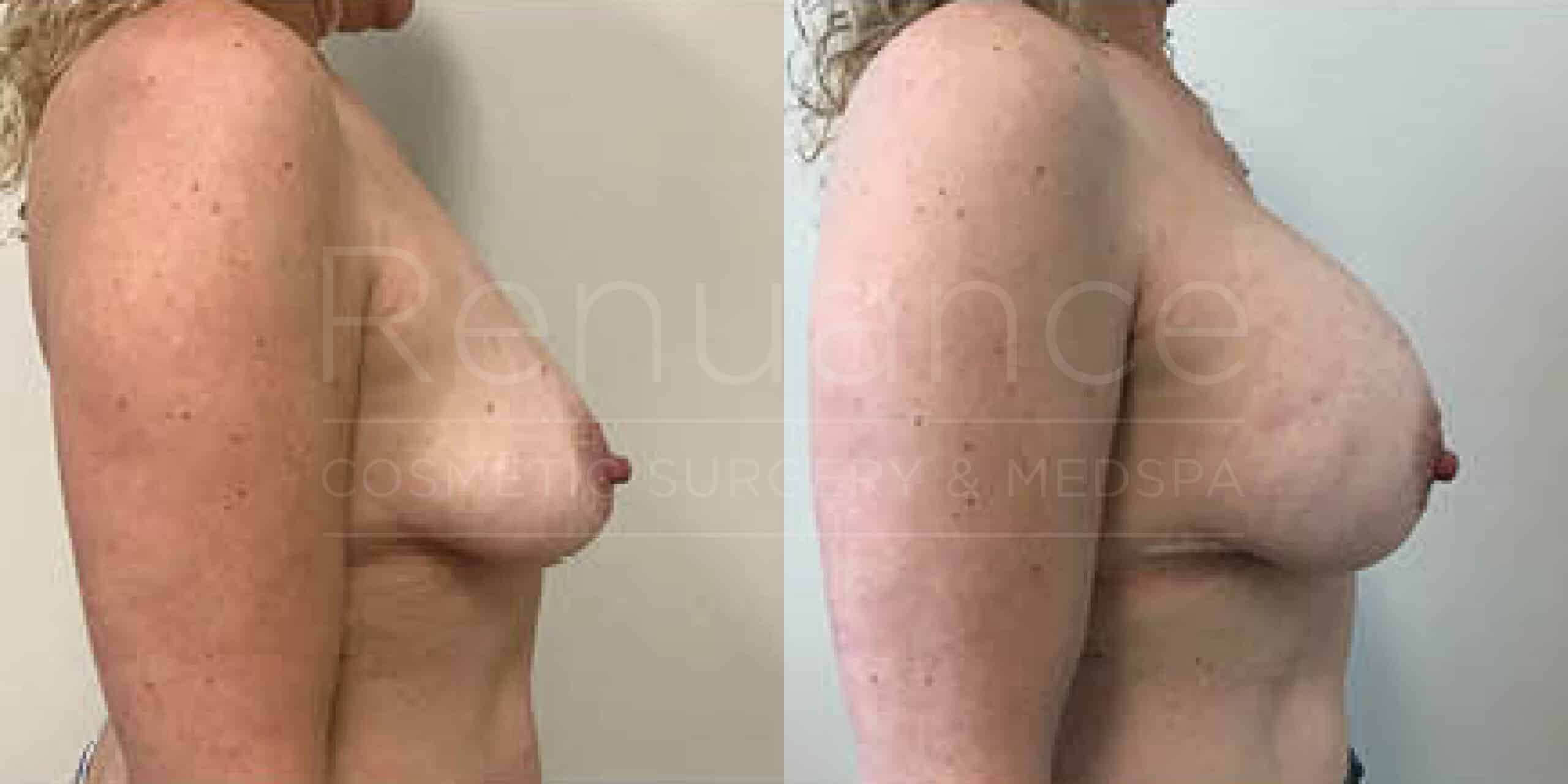 Before/After Breast Augmentation