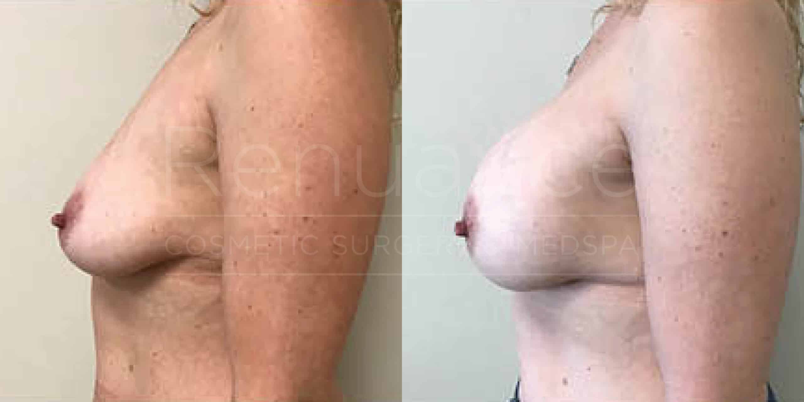 Before/After Breast Augmentation