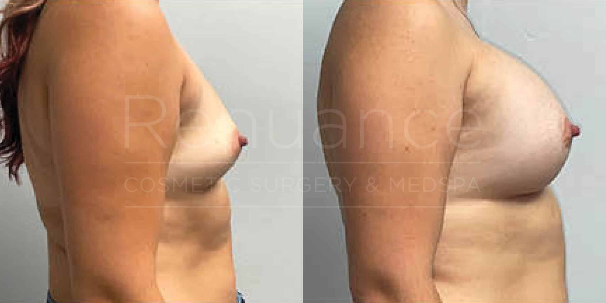 Before/After Breast Augmentation