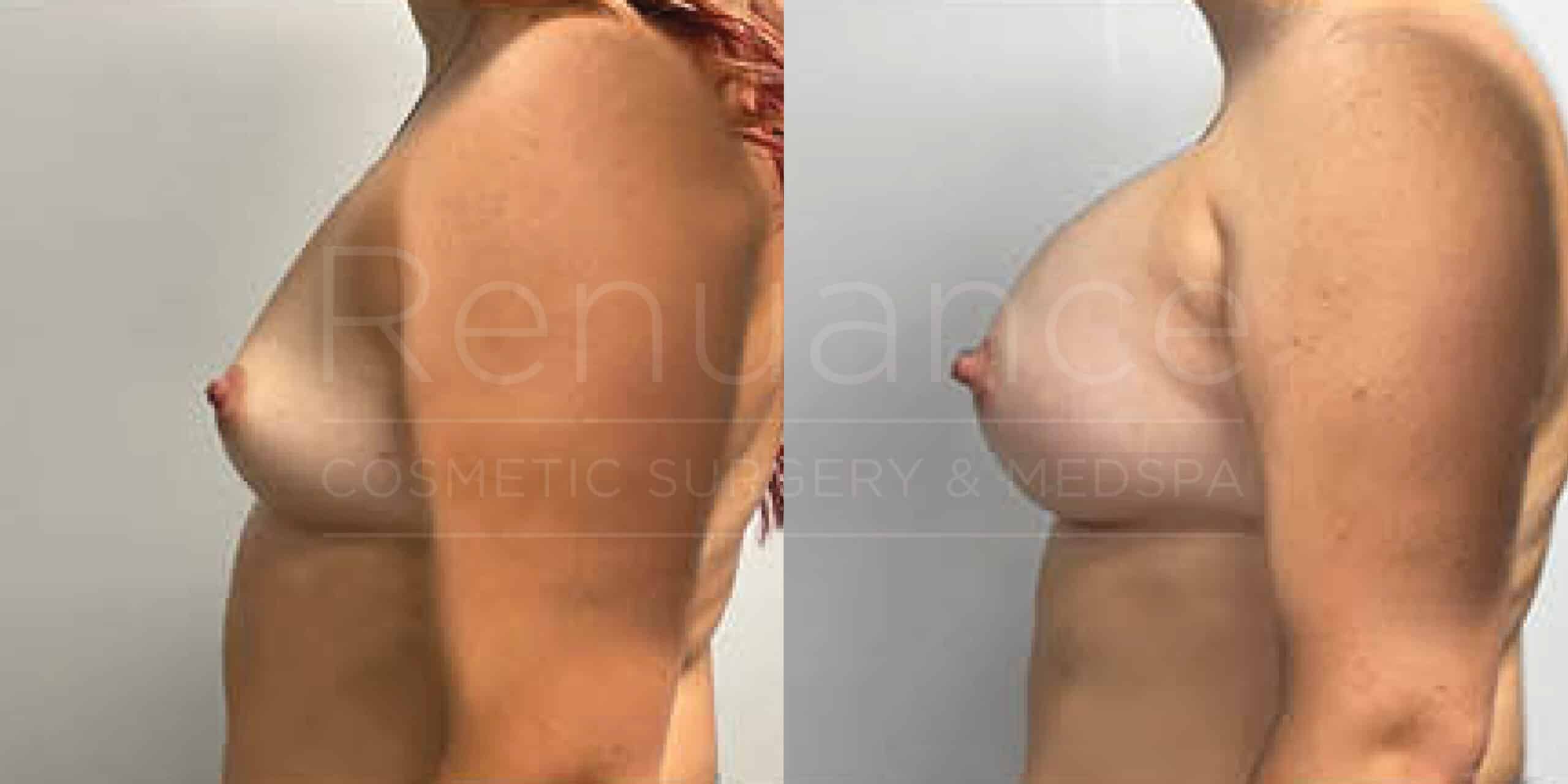 Before/After Breast Augmentation