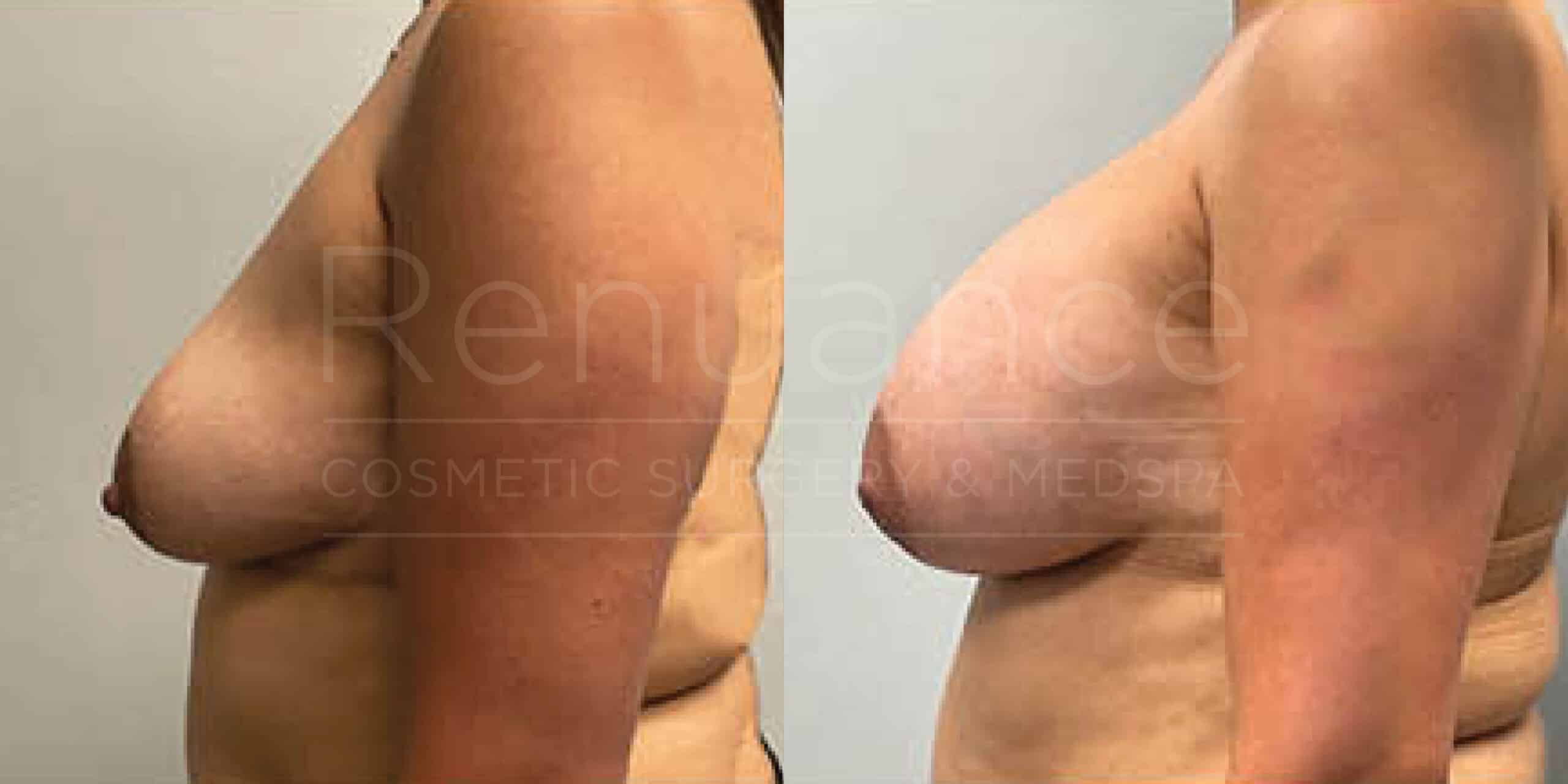 Before/After Breast Augmentation