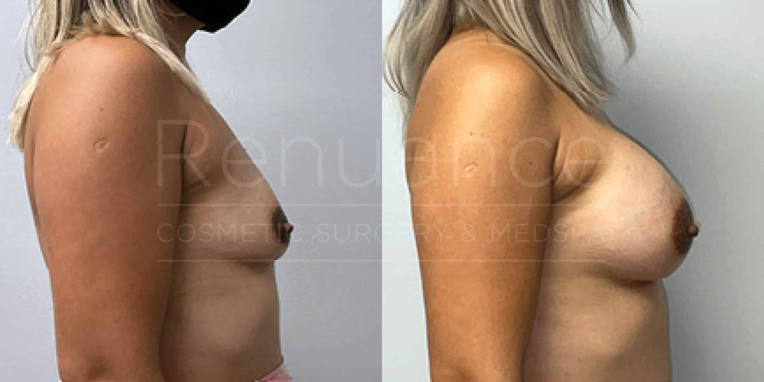 Before/After Breast Augmentation