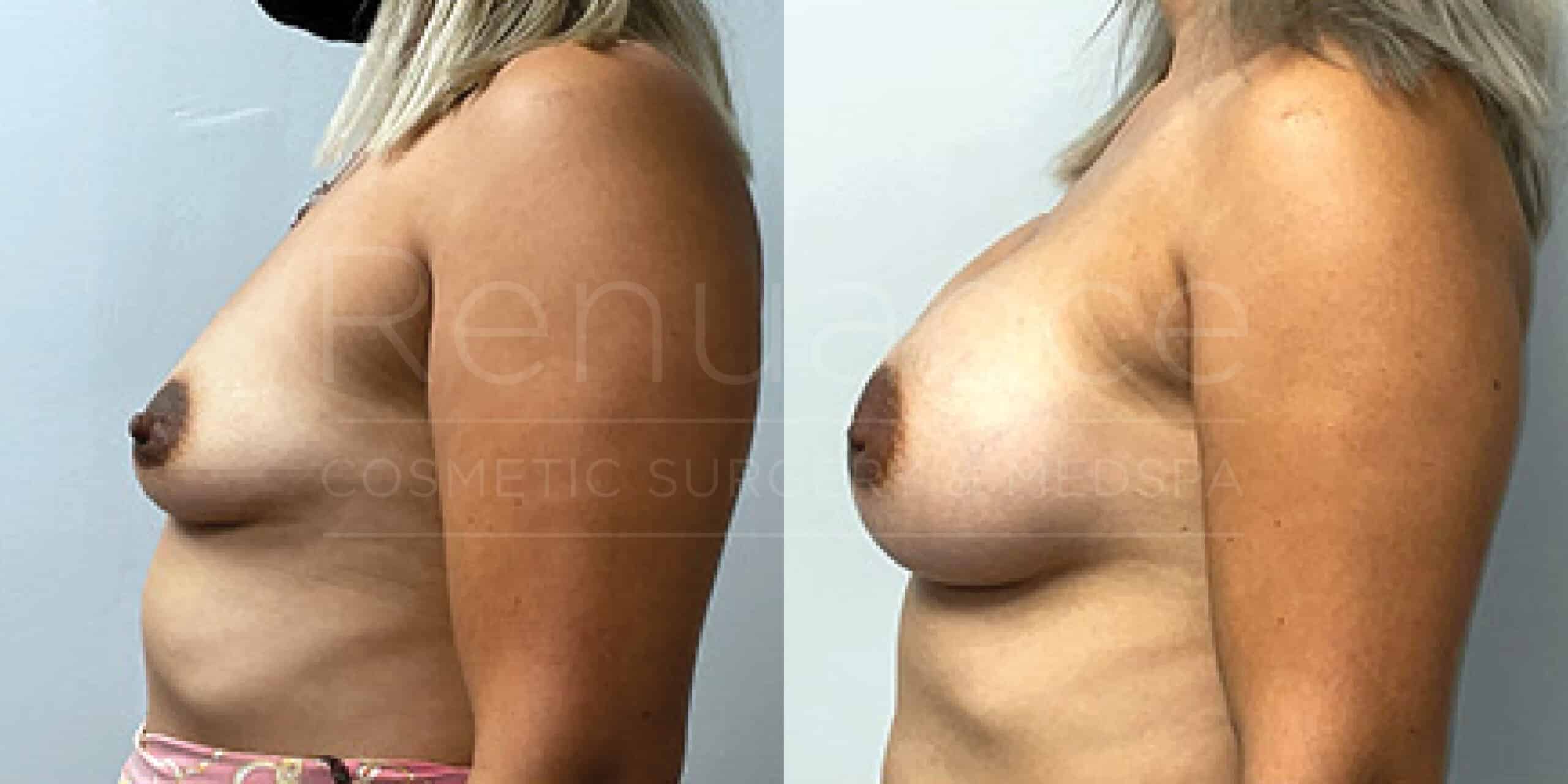 Before/After Breast Augmentation