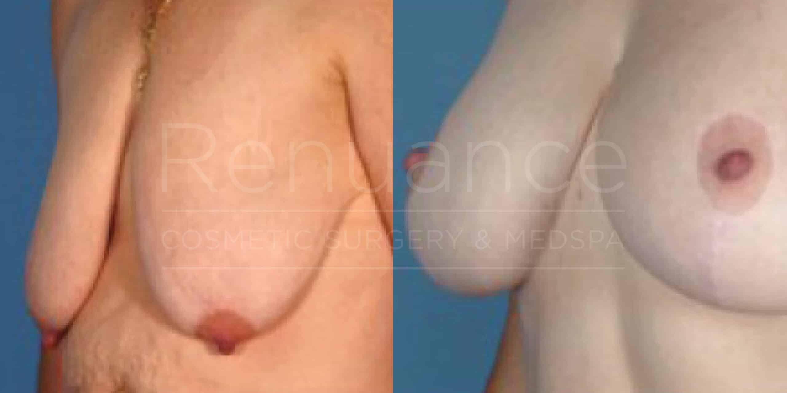 Before/After Breast Lift