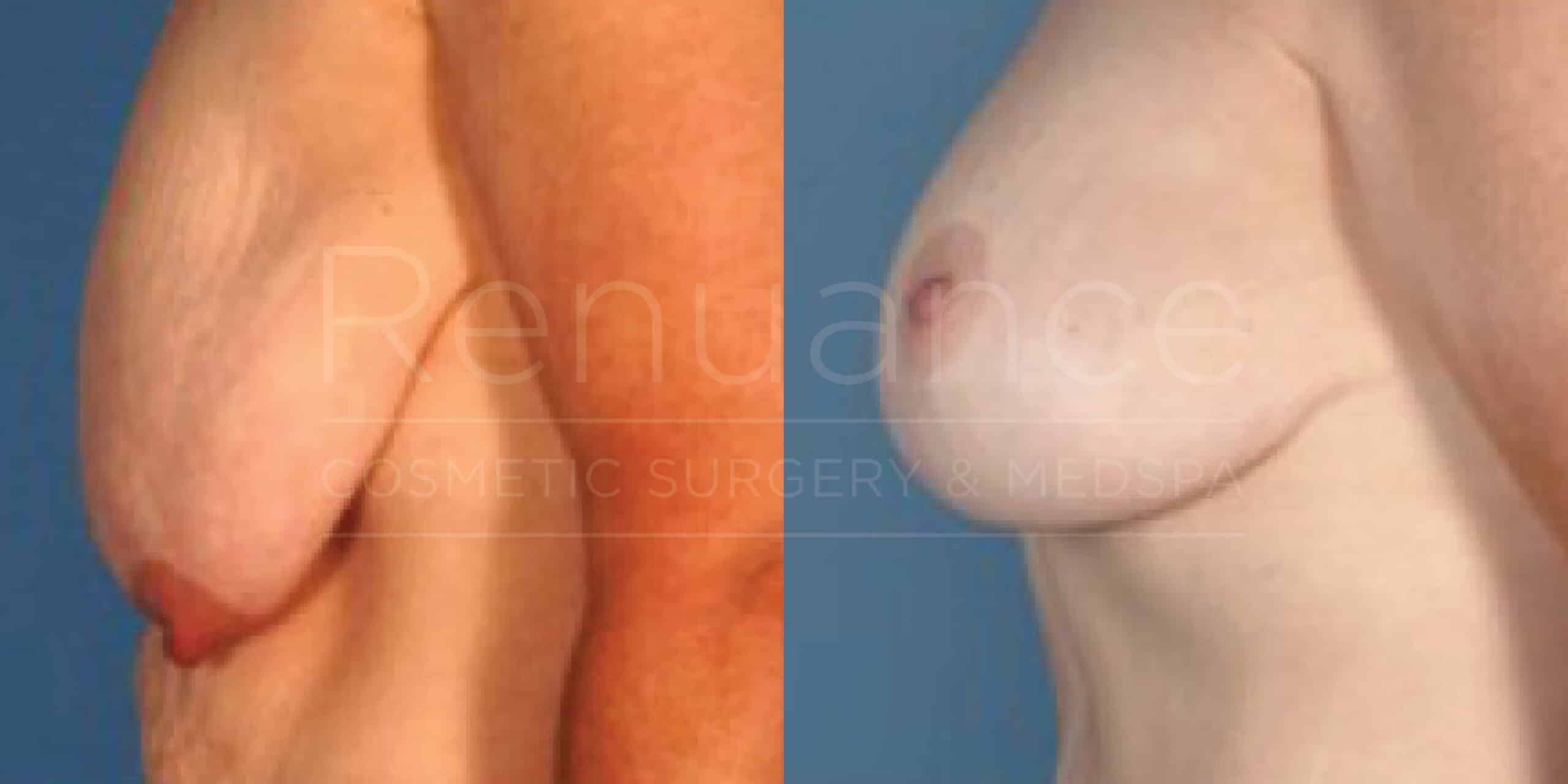 Before/After Breast Lift