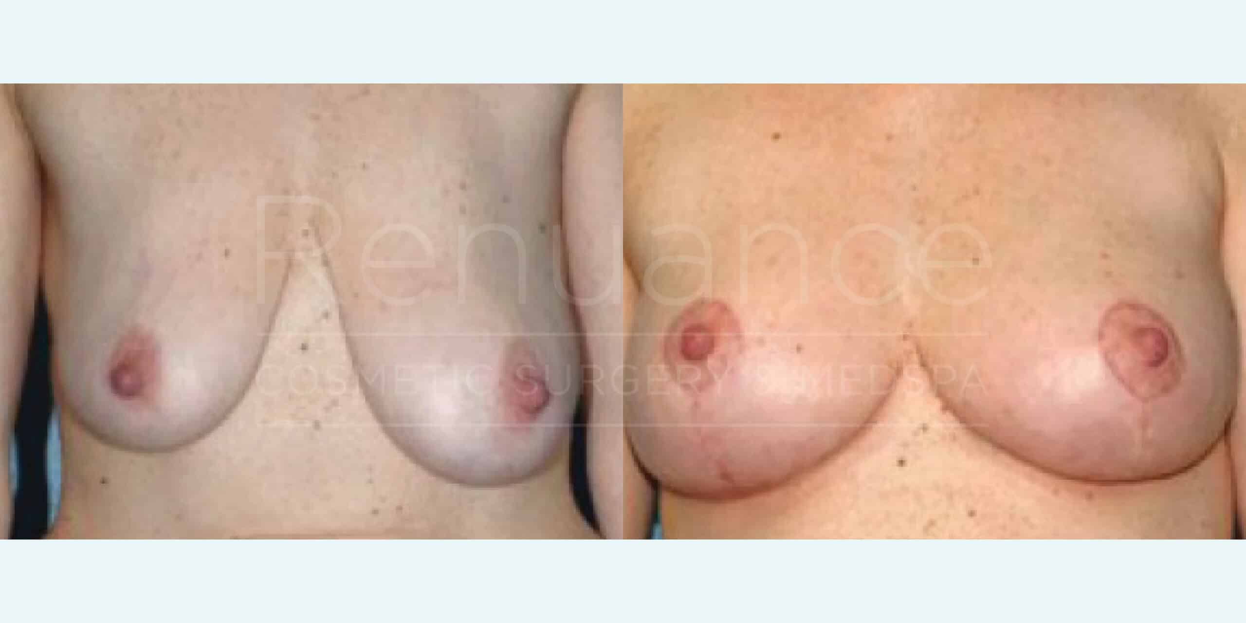 Before/After Breast Lift