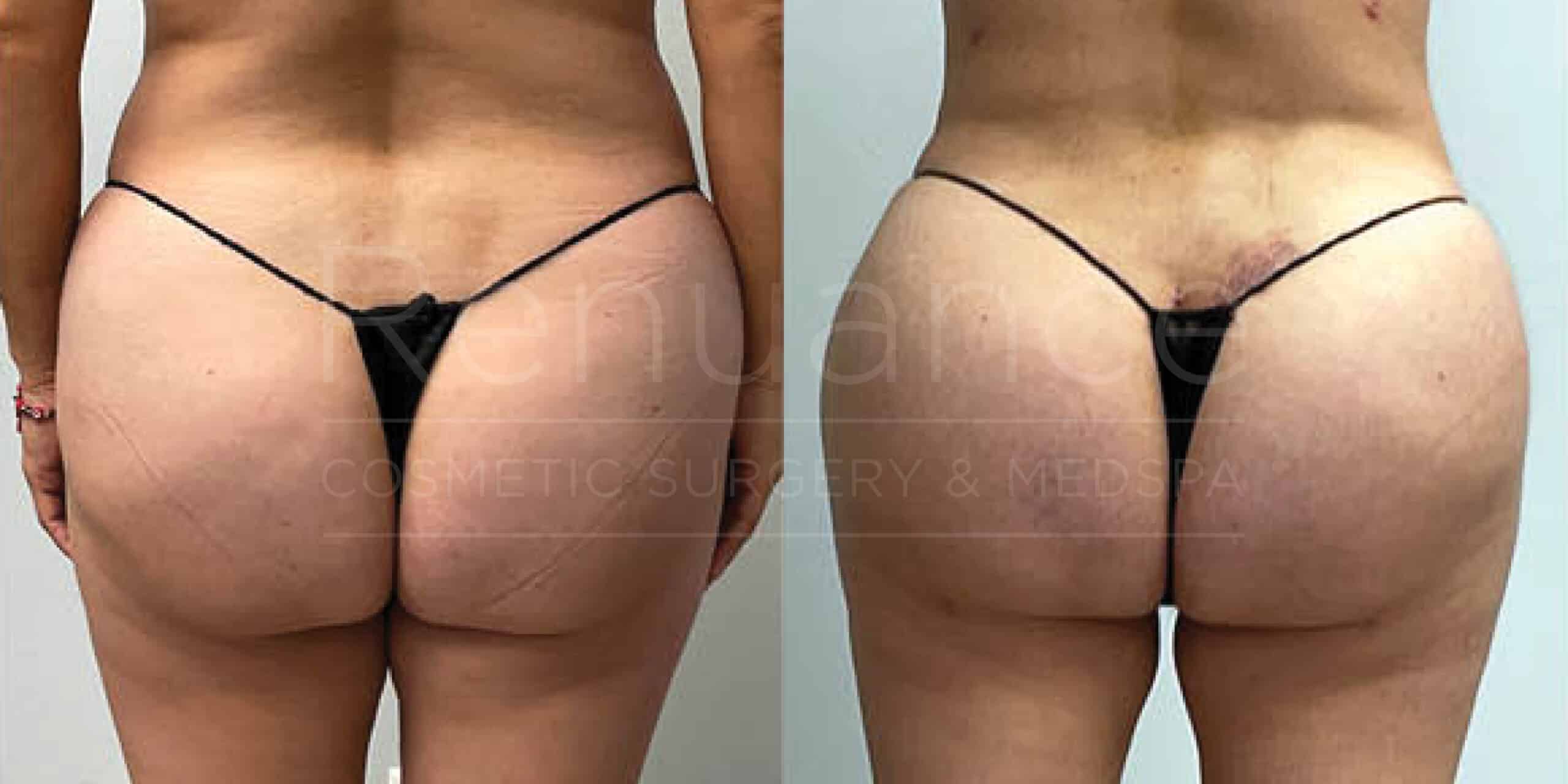 Before/After Glute Augmentation
