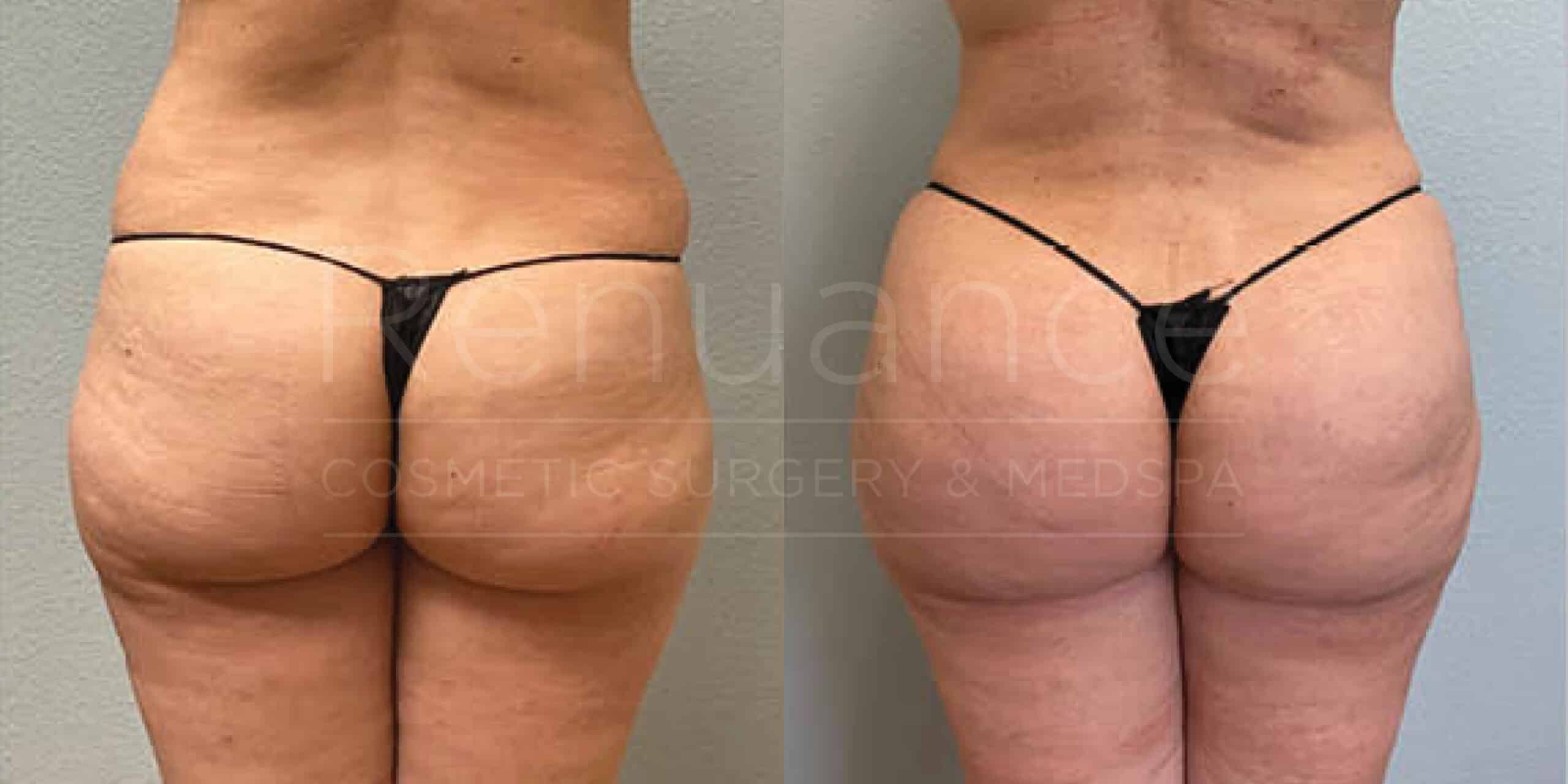 Before/After Glute Augmentation