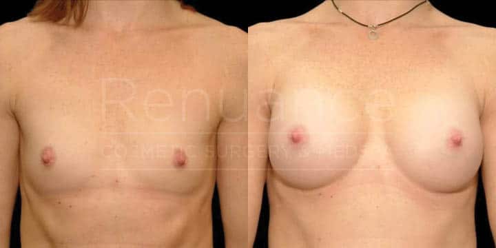 Renuance - breast augmentation by Jose Rodriguez, MD