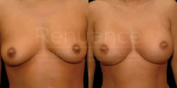 Renuance - breast augmentation by Jose Rodriguez, MD