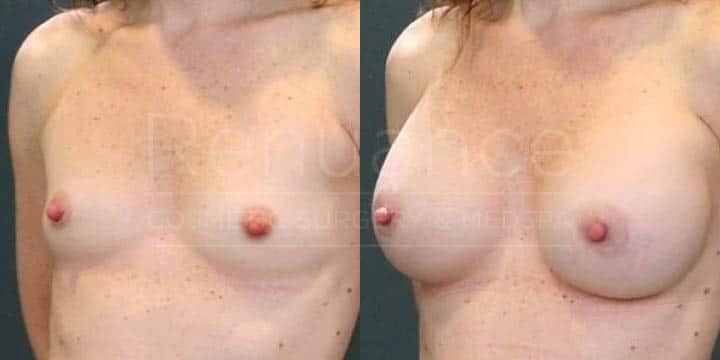 Renuance - breast augmentation by Jose Rodriguez, MD