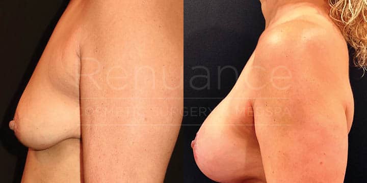 Renuance - breast augmentation by Jose Rodriguez, MD