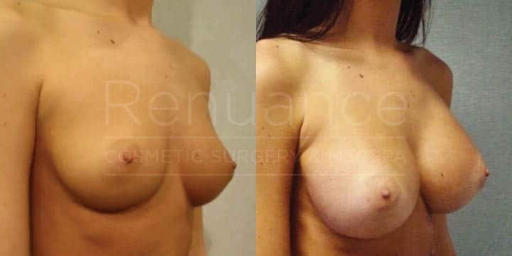 Renuance - breast augmentation by Jose Rodriguez, MD